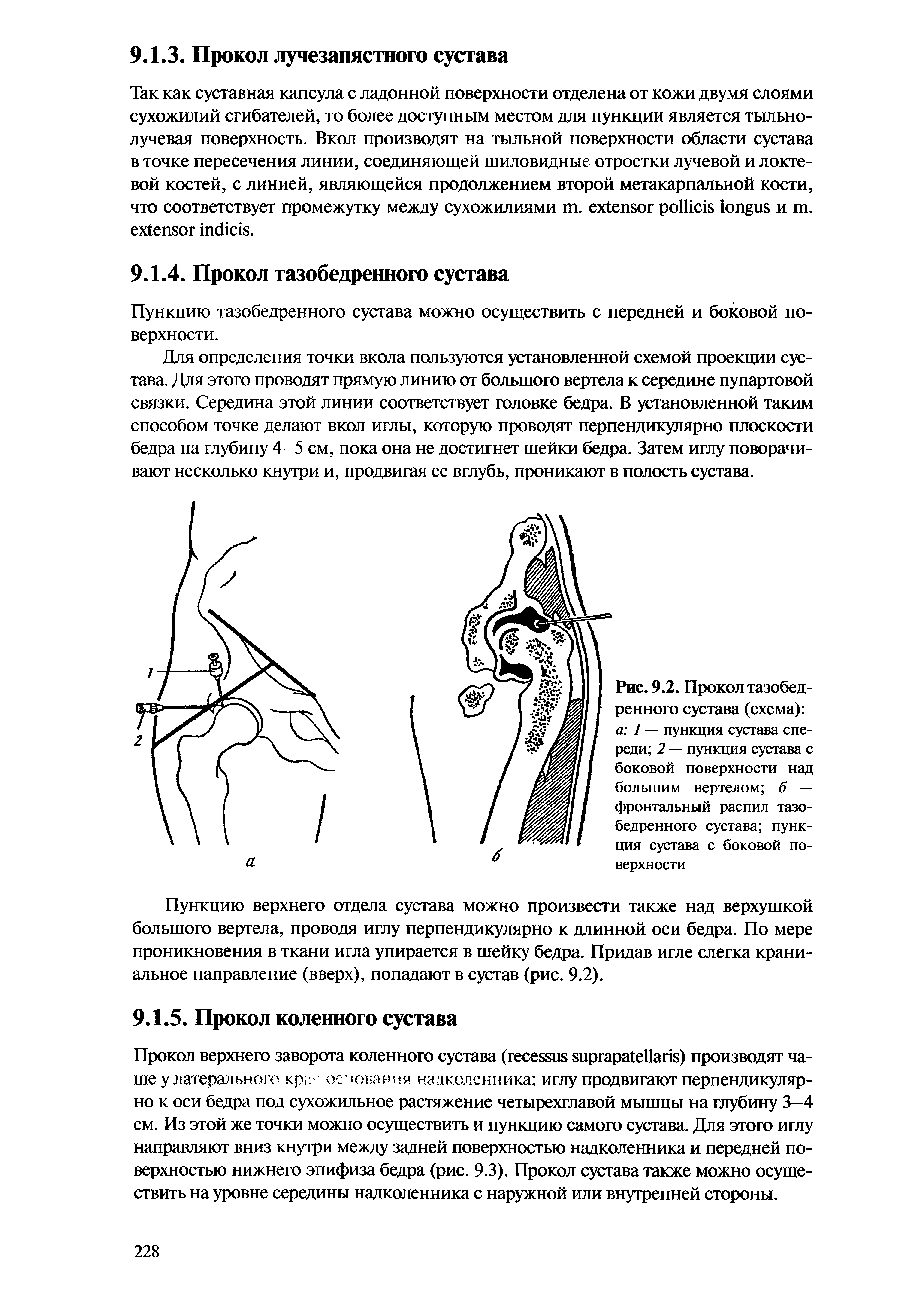 Рис. 9.2. Прокол тазобедренного сустава (схема) а 1 — пункция сустава спереди 2 — пункция сустава с боковой поверхности над большим вертелом б — фронтальный распил тазобедренного сустава пункция сустава с боковой поверхности...