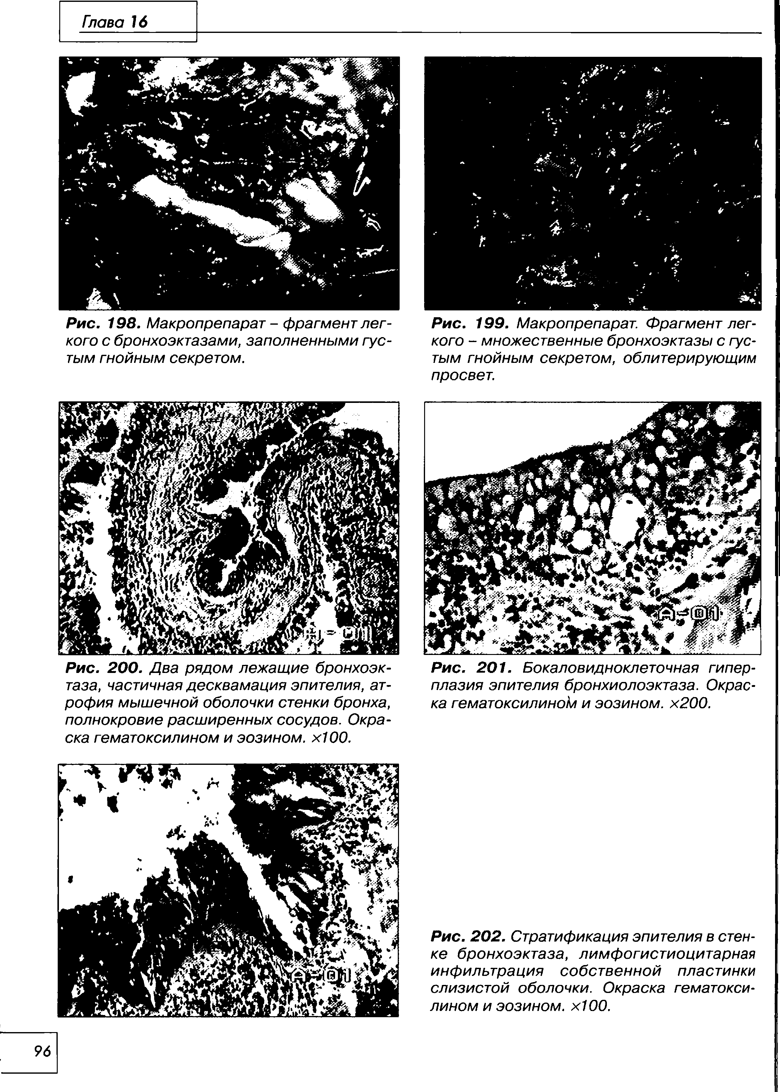 Рис. 198. Макропрепарат - фрагмент легкого с бронхоэктазами, заполненными густым гнойным секретом.