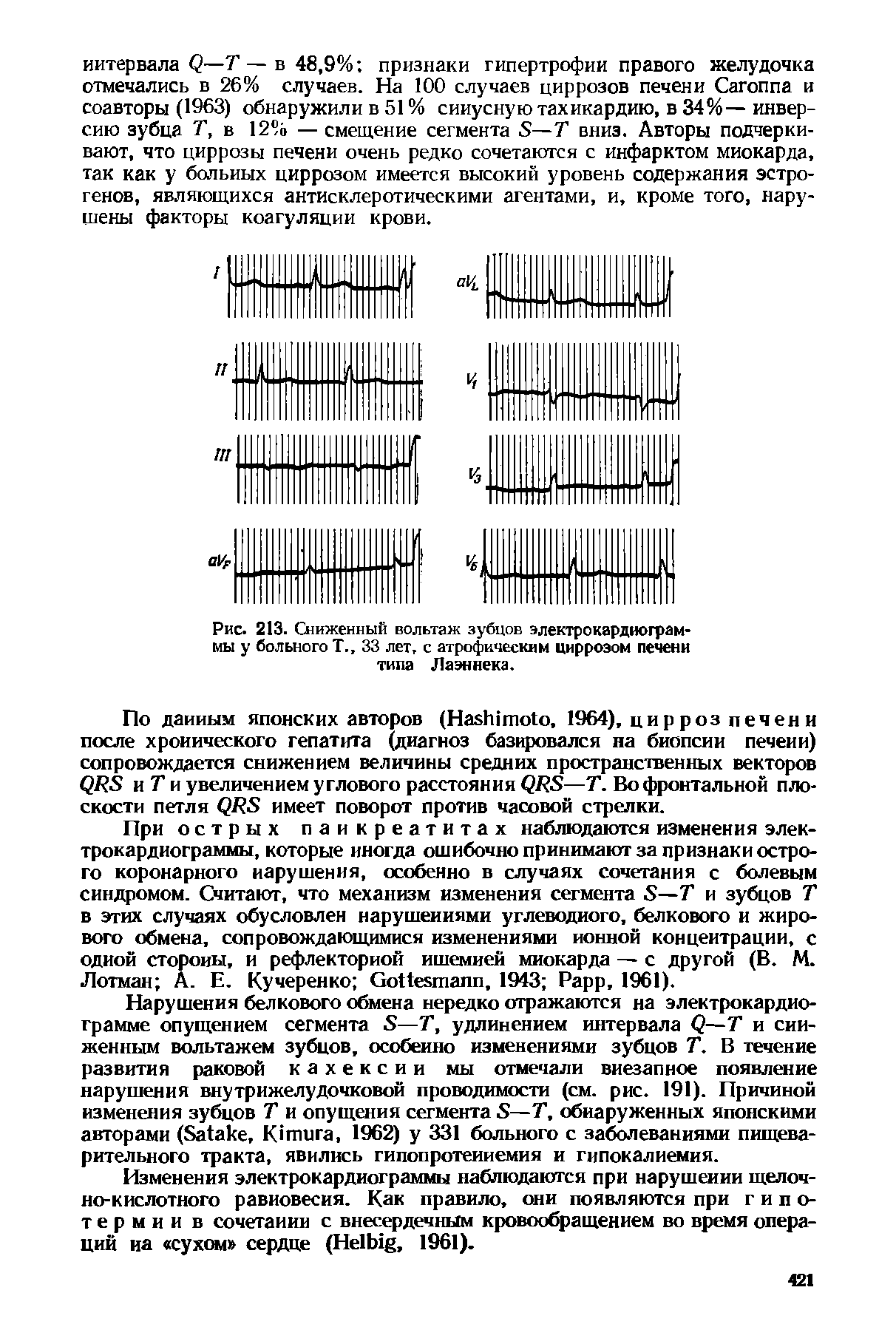 Рис. 213. Сниженный вольтаж зубцов электрокардиограммы у больного Т., 33 лет. с атрофическим циррозом печени типа Лаэннека.