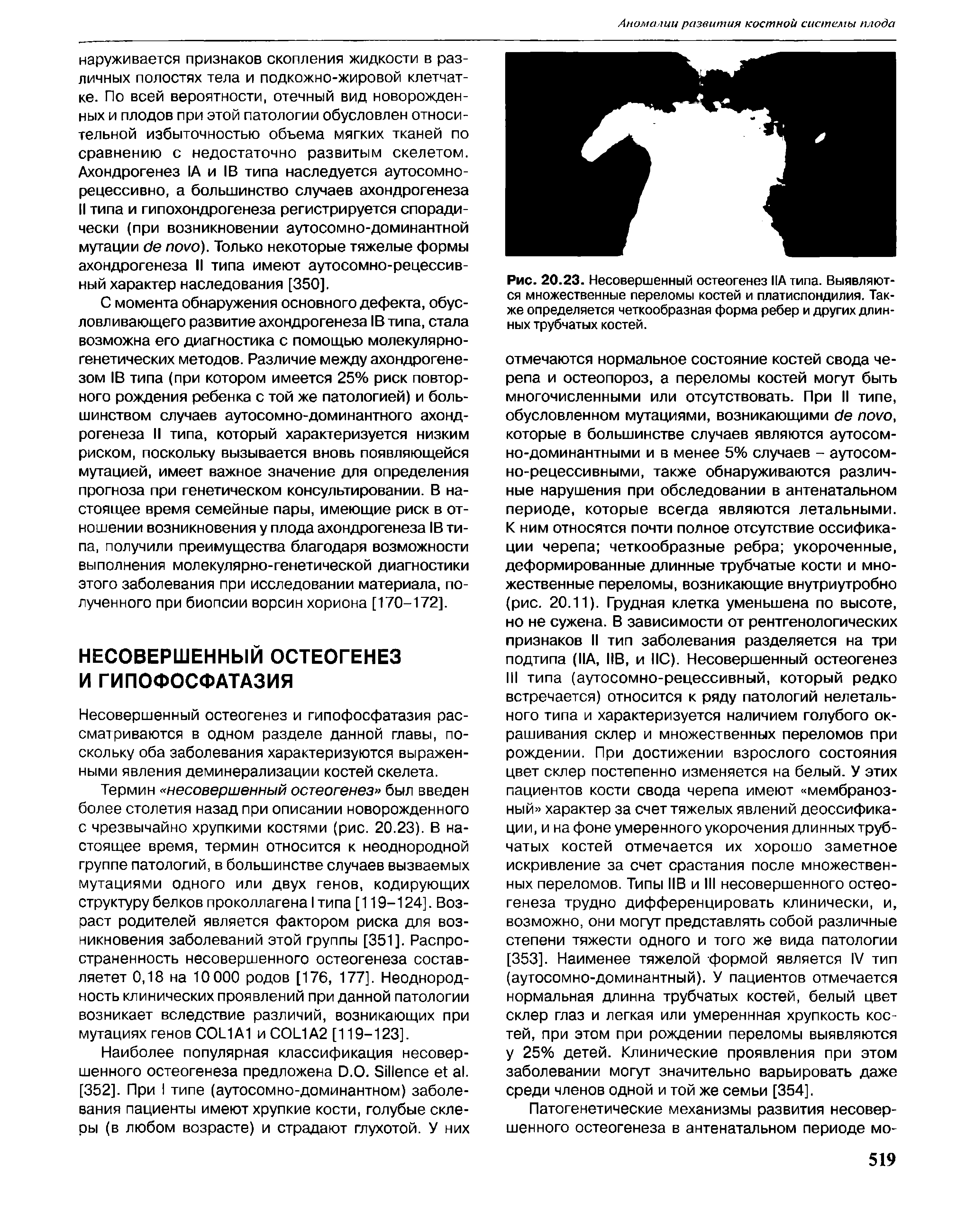 Рис. 20.23. Несовершенный остеогенез ПА типа. Выявляются множественные переломы костей и платиспондилия. Также определяется четкообразная форма ребер и других длинных трубчатых костей.