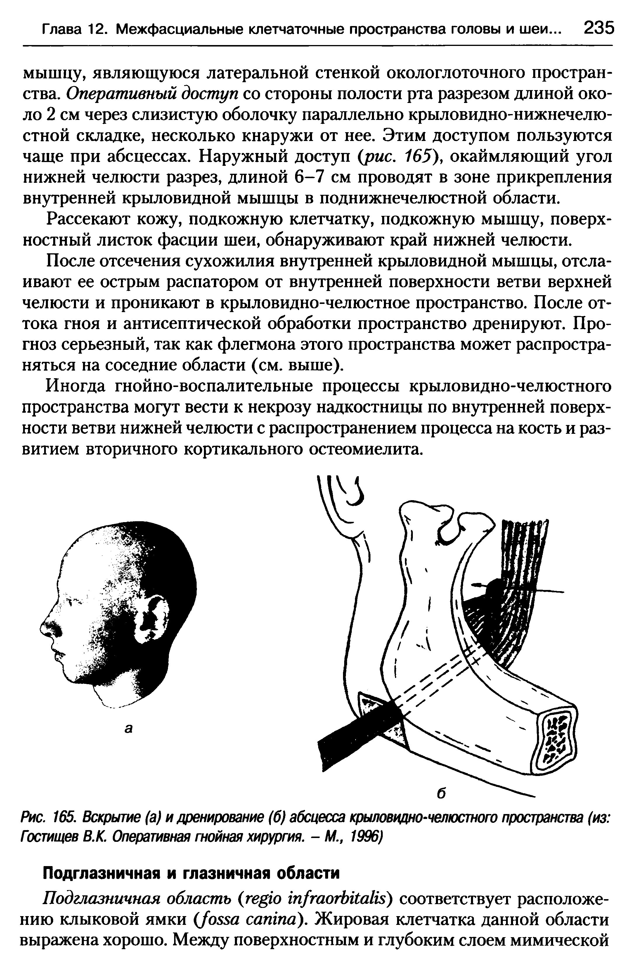 Рис. 165. Вскрытие (а) и дренирование (б) абсцесса крыловидно-челюстного пространства (из ...