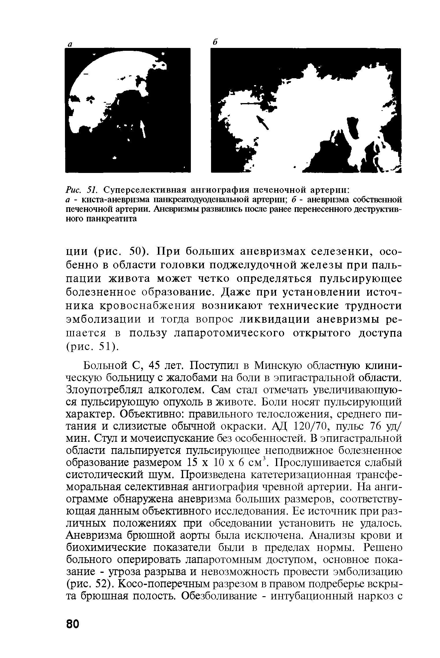 Рис. 51. Суперселективная ангиография печеночной артерии а - киста-аневризма панкреатодуоденальной артерии б - аневризма собственной печеночной артерии. Аневризмы развились после ранее перенесенного деструктивного панкреатита...