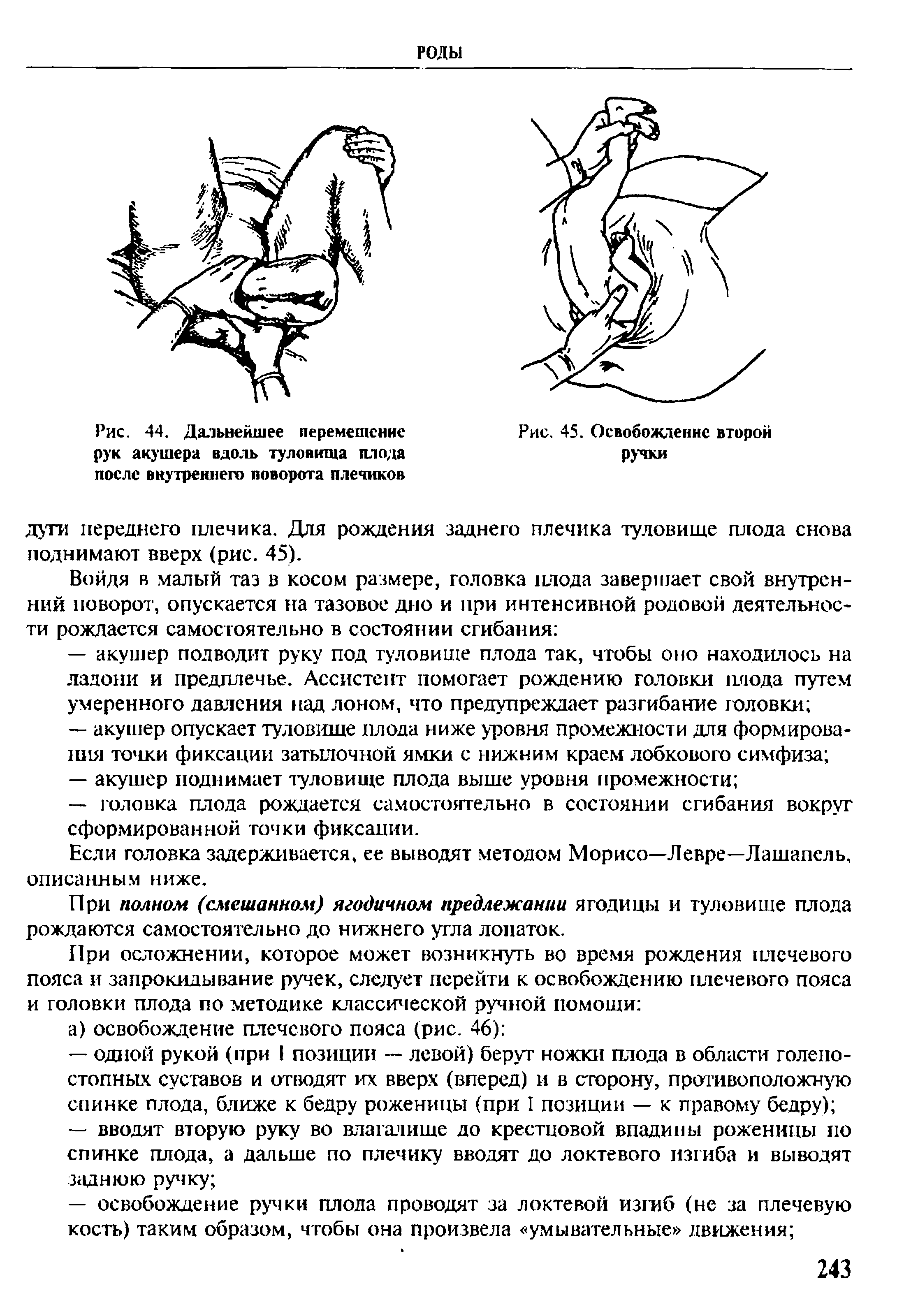 Рис. 44. Дальнейшее перемещение рук акушера вдоль туловища плода после внутреннего поворота плечиков...