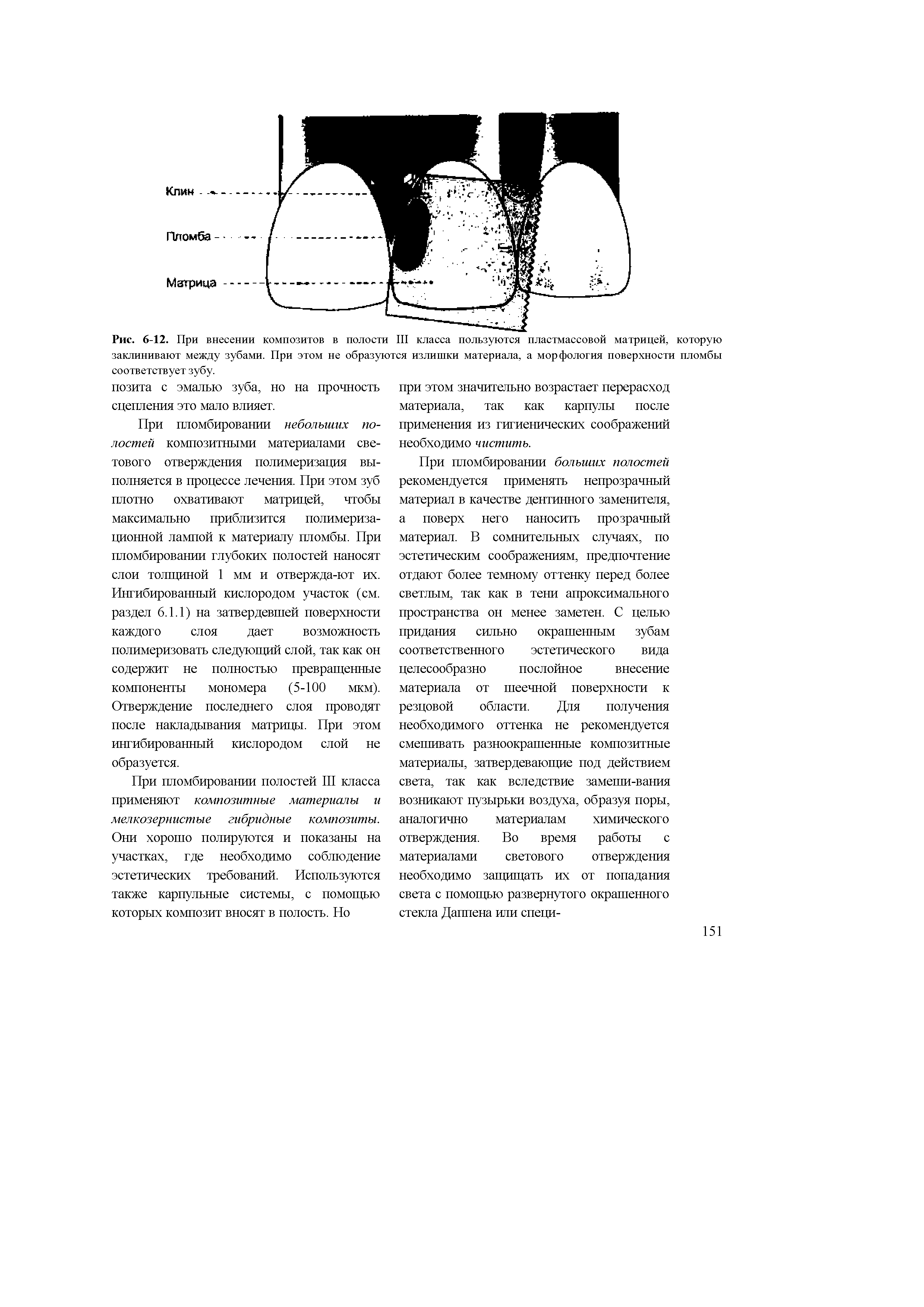Рис. 6-12. При внесении композитов в полости III класса пользуются пластмассовой матрицей, которую...
