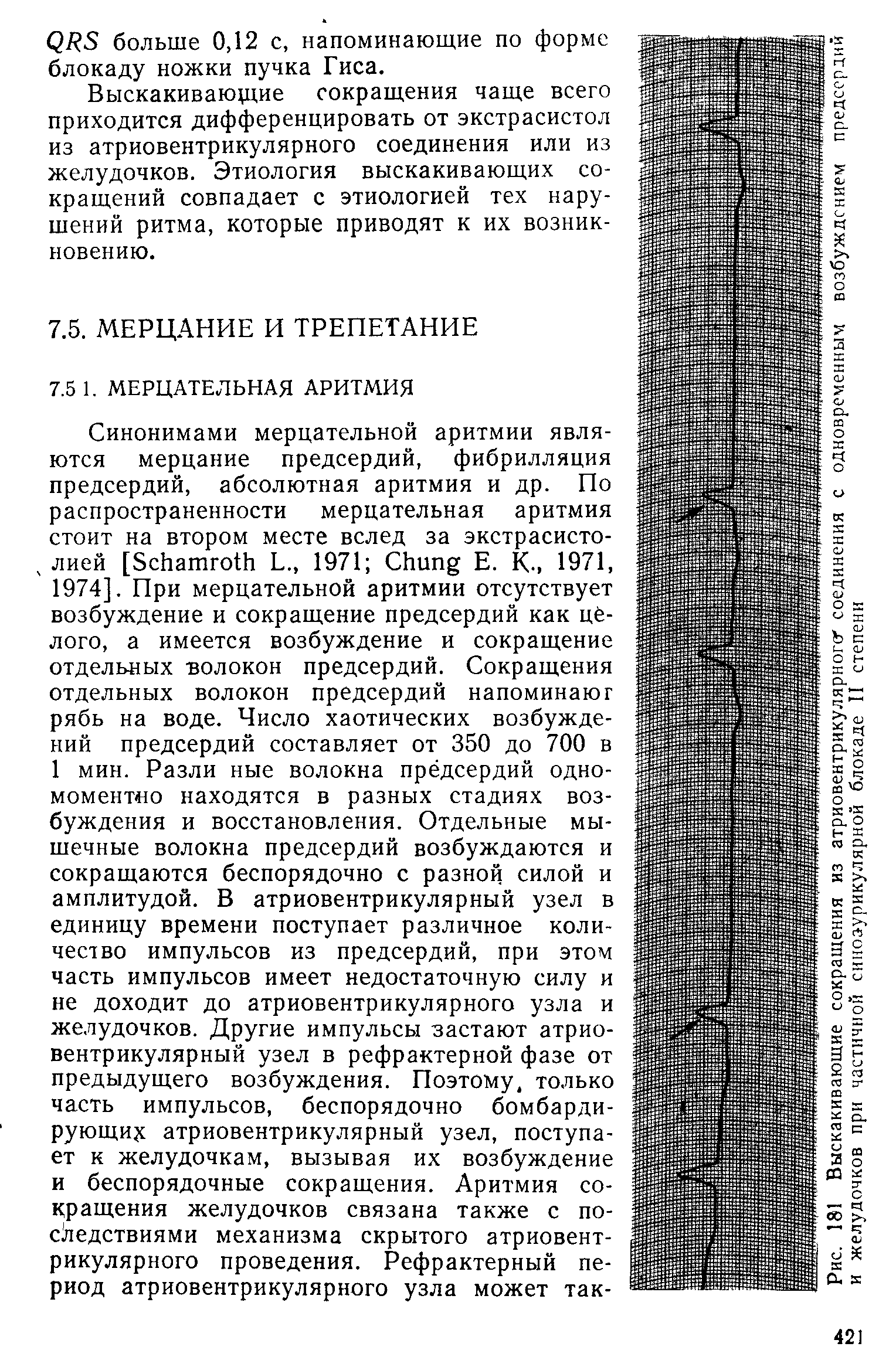 Рис. 181 Выскакивающие сокращения из атриовентрикулярного соединения с одновременным возбуждением предсердий и желудочков при частичной синоаурикулярной блокаде II степени...