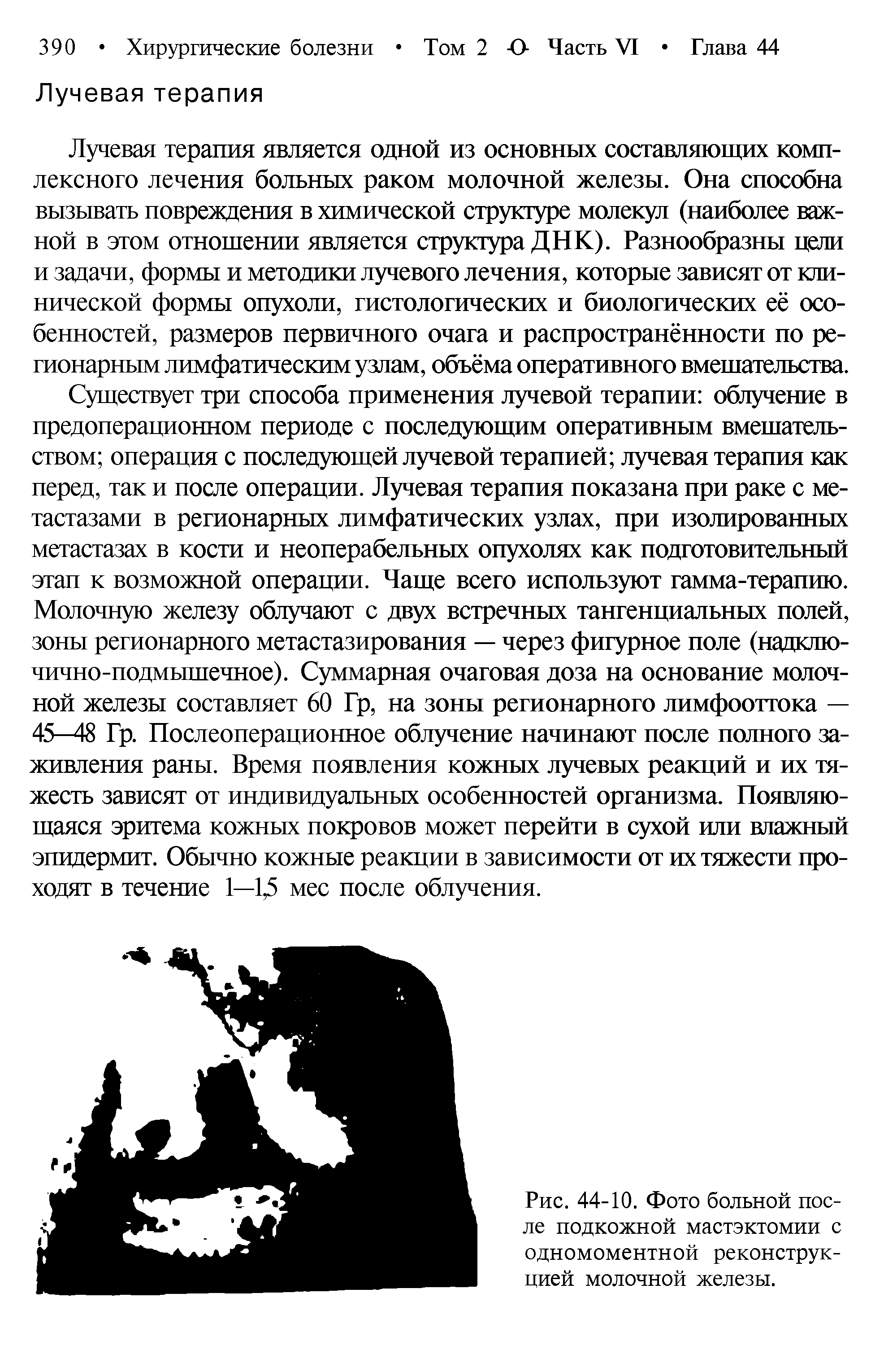 Рис. 44-10. Фото больной после подкожной мастэктомии с одномоментной реконструкцией молочной железы.