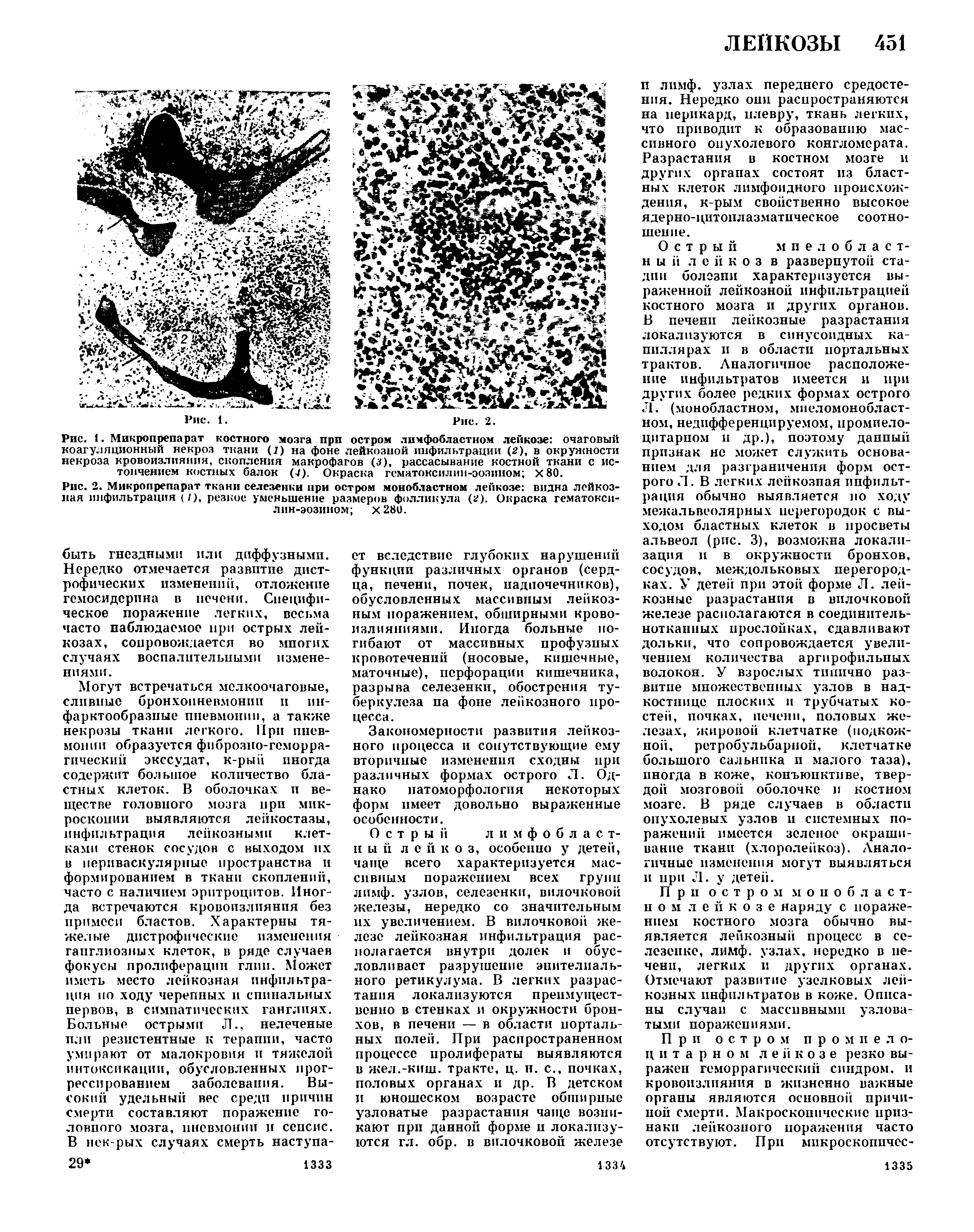 Рис. 1. Микропрепарат костного мозга при остром лимфобластном лейкозе очаговый коагуляционный некроз ткани (1) на фоне лейкозной инфильтрации (2), в окружности некроза кровоизлияния, скопления макрофагов (з), рассасывание костной ткани с истончением костных балок (7). Окраска гематоксилнн-эозином Х80.