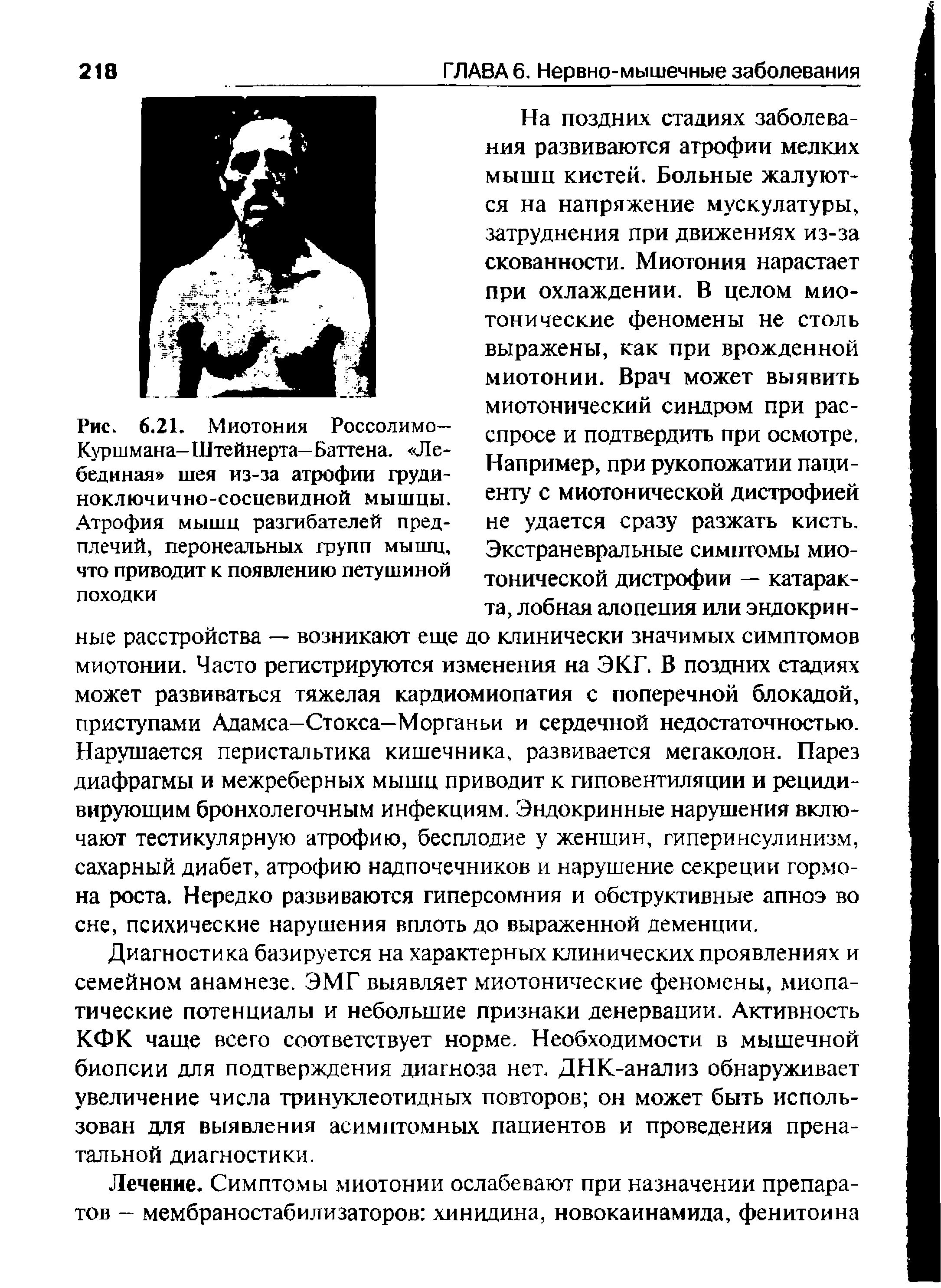 Рис. 6.21. Миотония Россолимо— Куршмана-Штейнерта-Баттена. Лебединая шея из-за атрофии грудиноключично-сосцевидной мышцы. Атрофия мышц разгибателей предплечий, перонеальных групп мышц, что приводит к появлению петушиной походки...