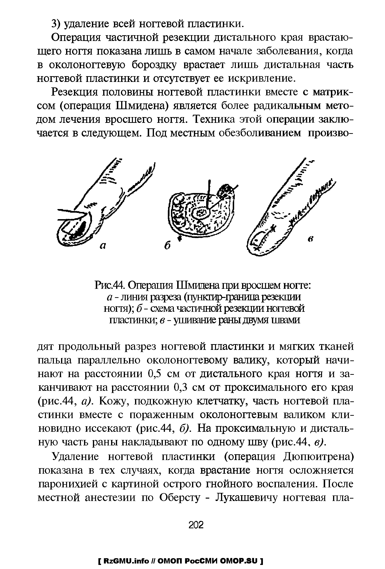 Рис.44. Операция Шмидена при вросшем ногте а - линия разреза (пункгир-траница резекции ногтя) б - схема частичной резекции ногтевой пластинки в - ушивание раны двумя швами...