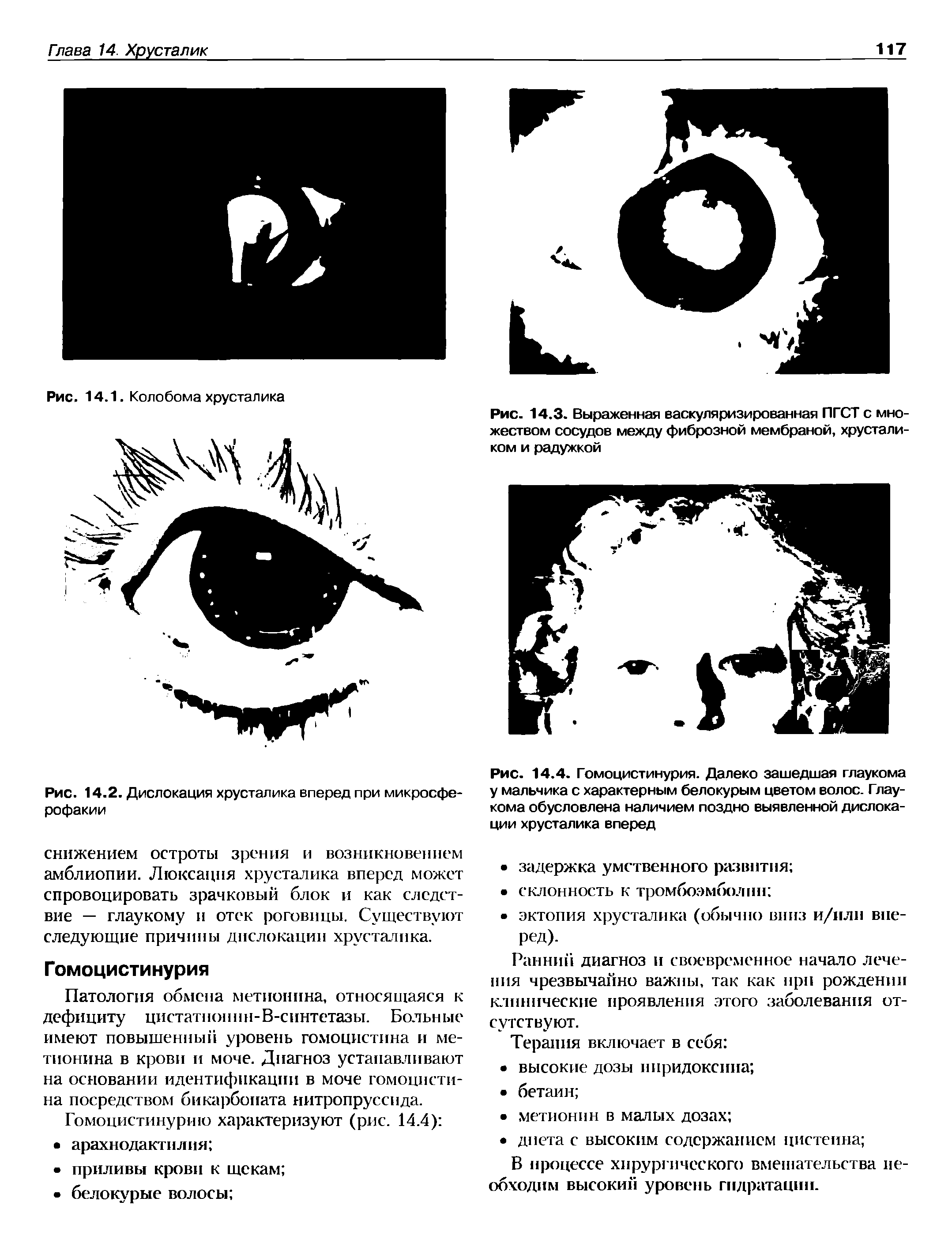 Рис. 14.4. Гомоцистинурия. Далеко зашедшая глаукома у мальчика с характерным белокурым цветом волос. Глаукома обусловлена наличием поздно выявленной дислокации хрусталика вперед...