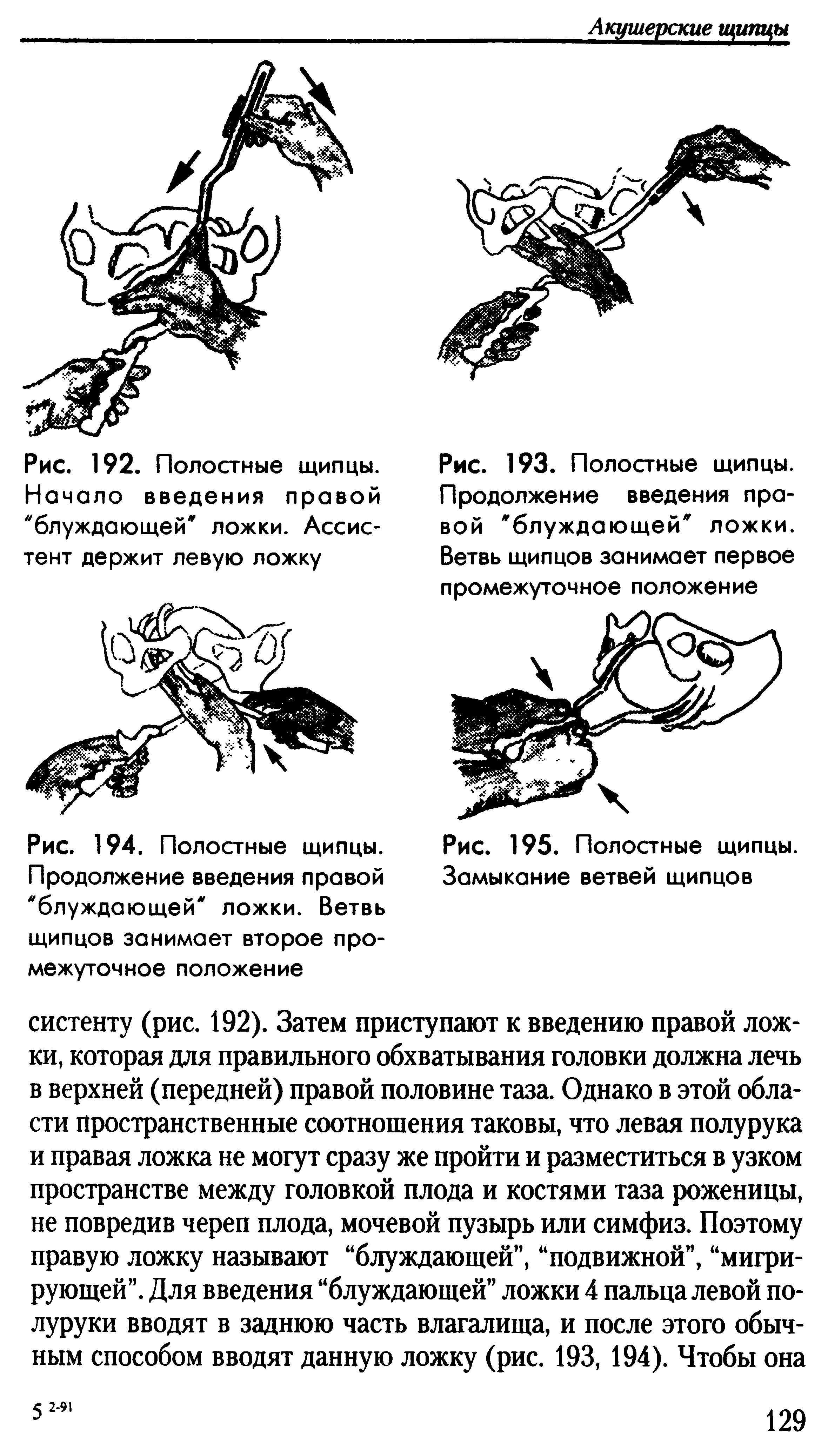 Рис. 193. Полостные щипцы. Продолжение введения правой блуждающей ложки. Ветвь щипцов занимает первое промежуточное положение...