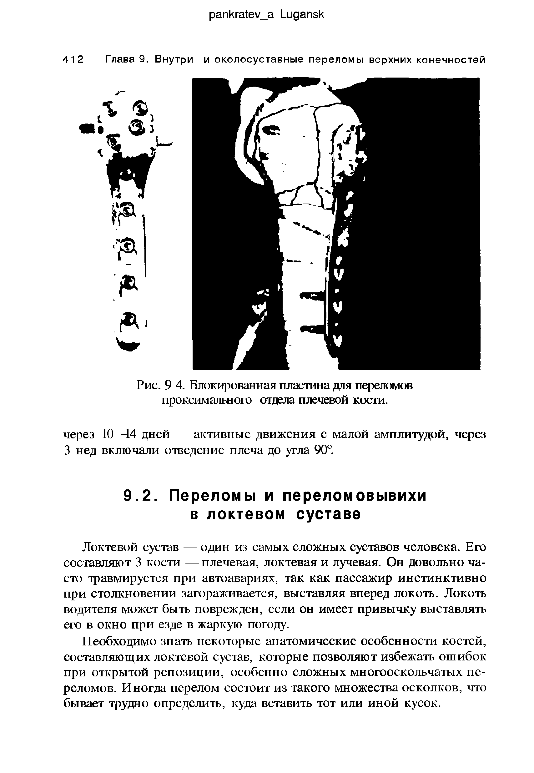 Рис. 9 4. Блокированная пластина для переломов проксимального отдела плечевой кости.