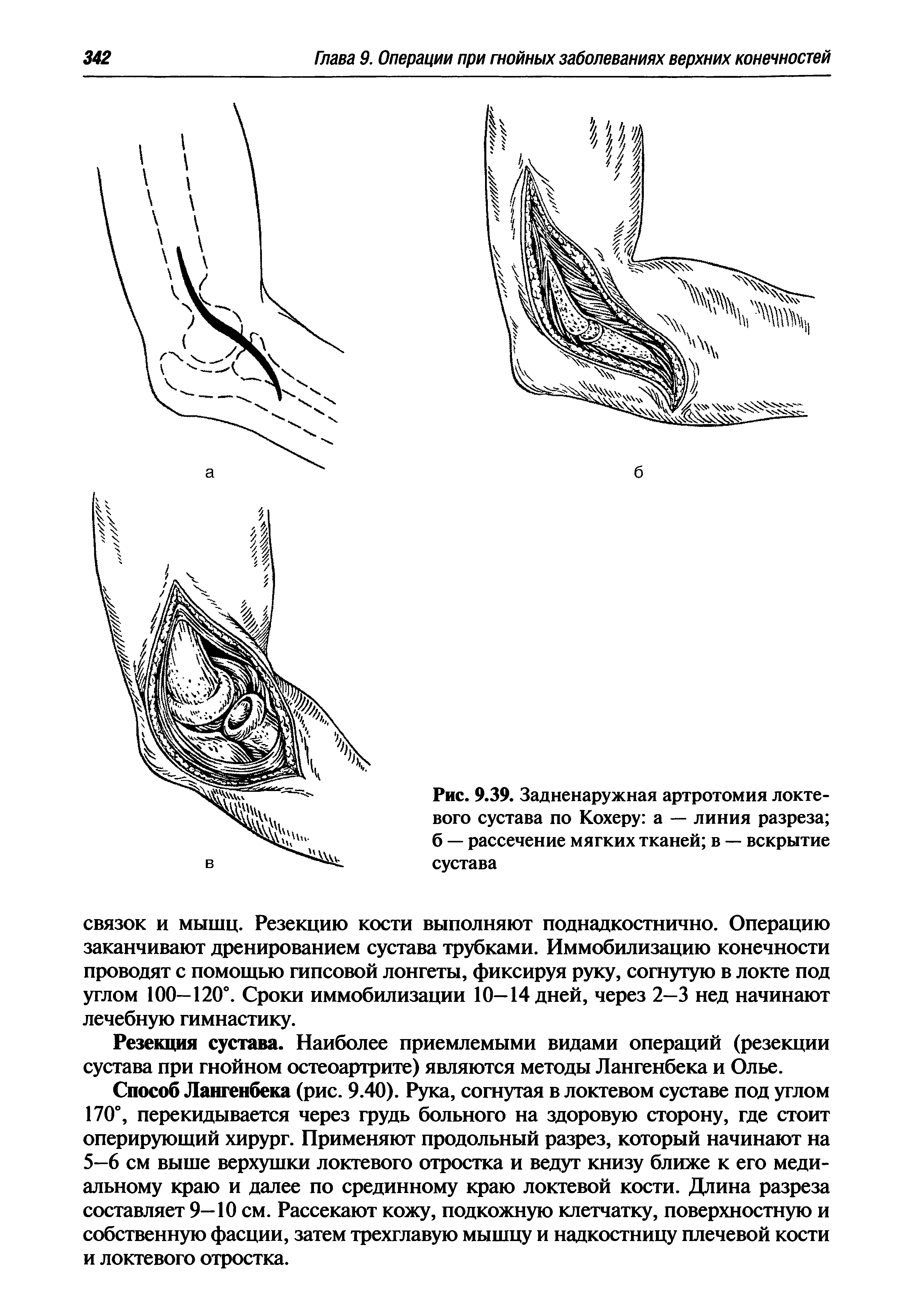 Рис. 9.39. Задненаружная артротомия локтевого сустава по Кохеру а — линия разреза б — рассечение мягких тканей в — вскрытие сустава...