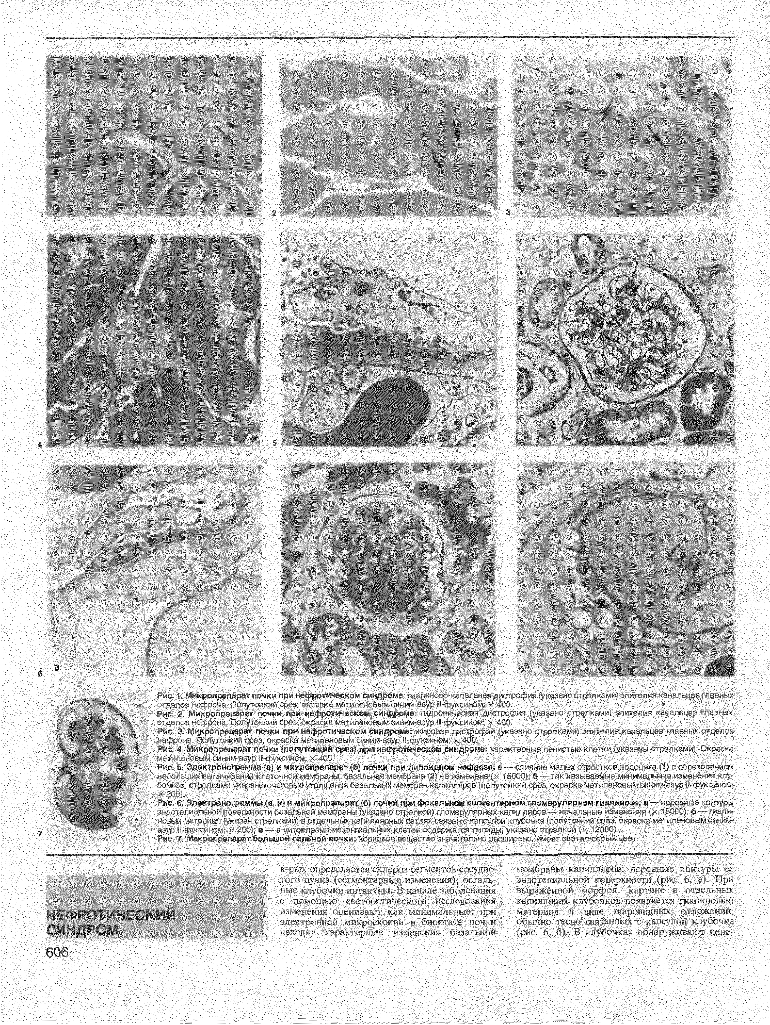 Рис. 6. Электронофаммы (а, в) и микролрепарат (6) почки при фокальном сегментарном гломерулярном гиалинозе а — ровный > онтуры...