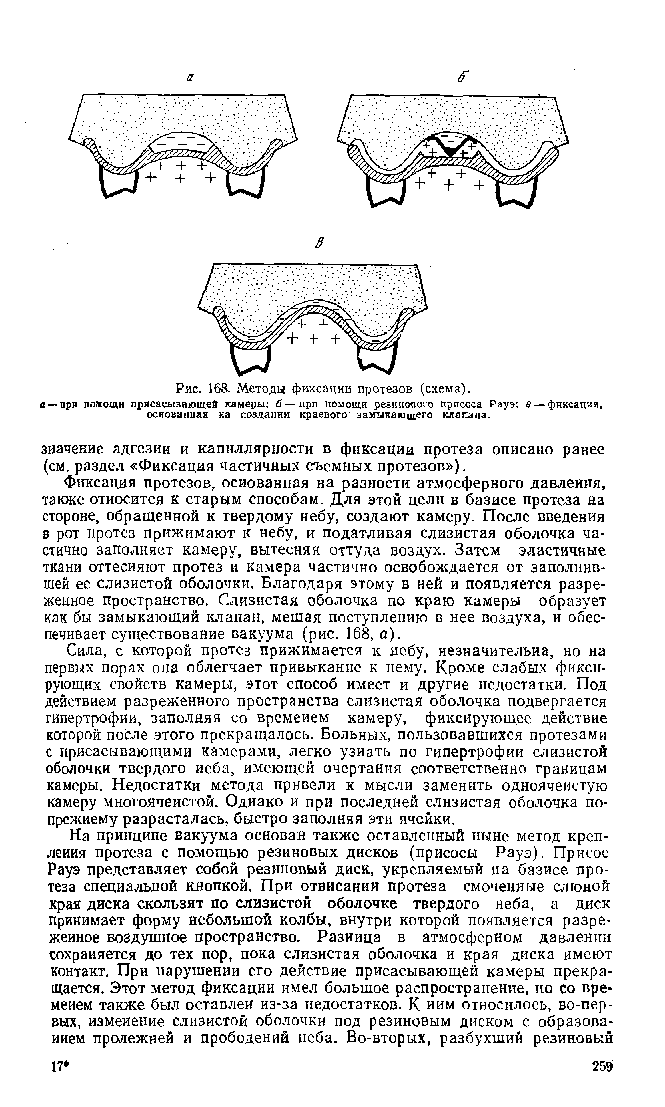 Рис. 168. Методы фиксации протезов (схема), о —при помощи присасывающей камеры б — при помощи резинового присоса Рауз в — фиксация, основанная на создании краевого замыкающего клапана.