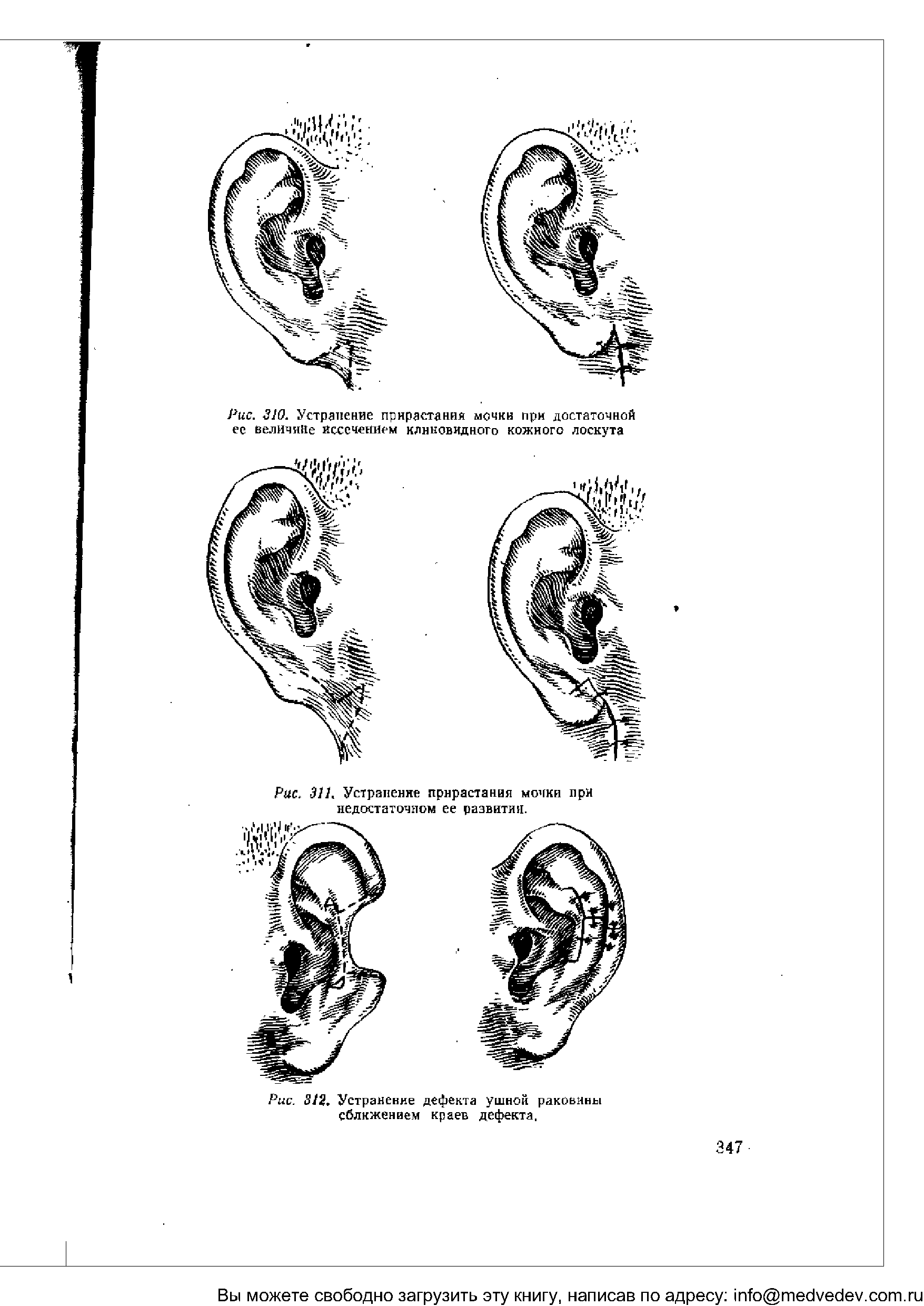 Рис. 312. Устранение дефекта ушной раковины сближением краев дефекта,...