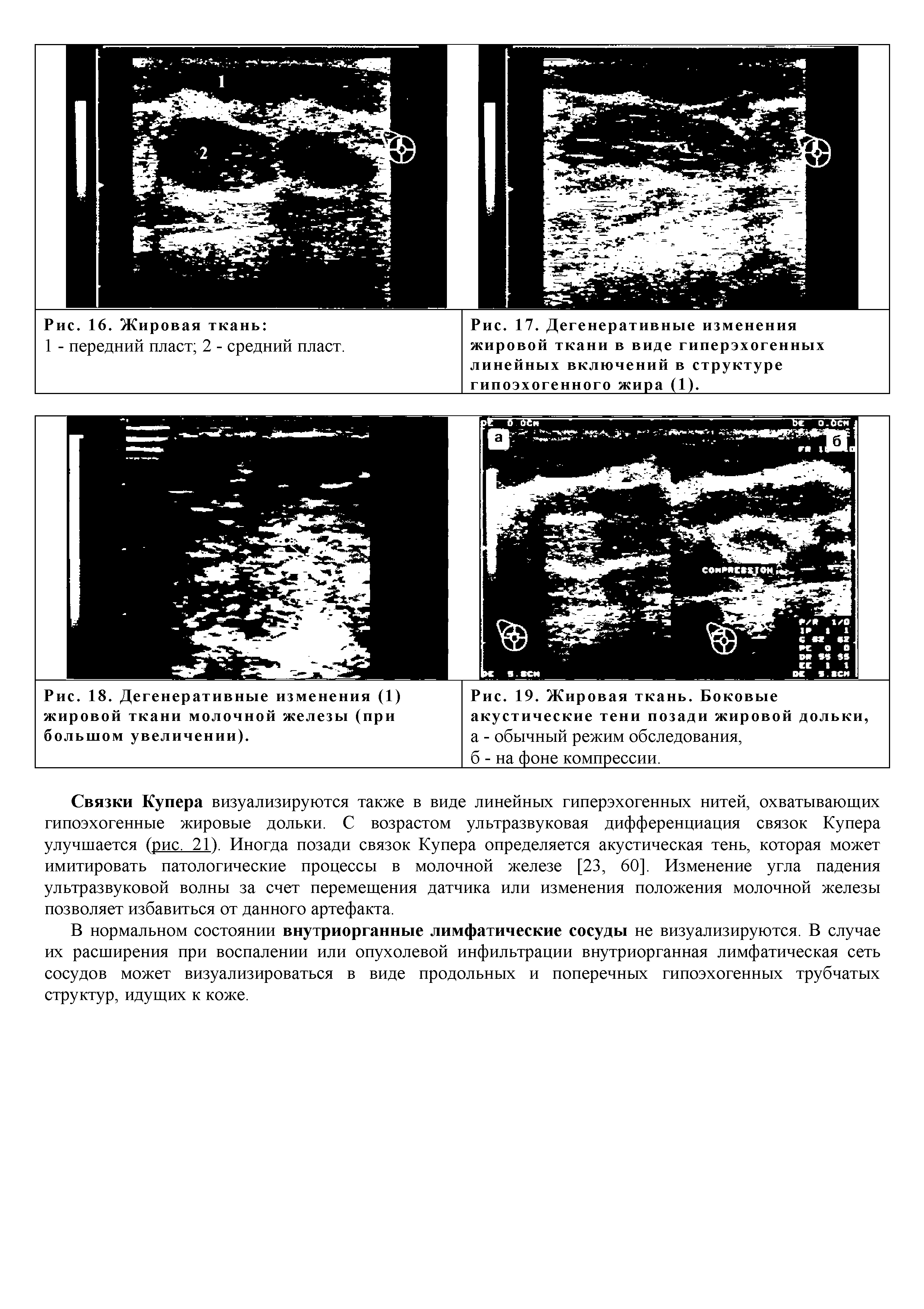 Рис. 19. Жировая ткань. Боковые акустические тени позади жировой дольки, а - обычный режим обследования,...