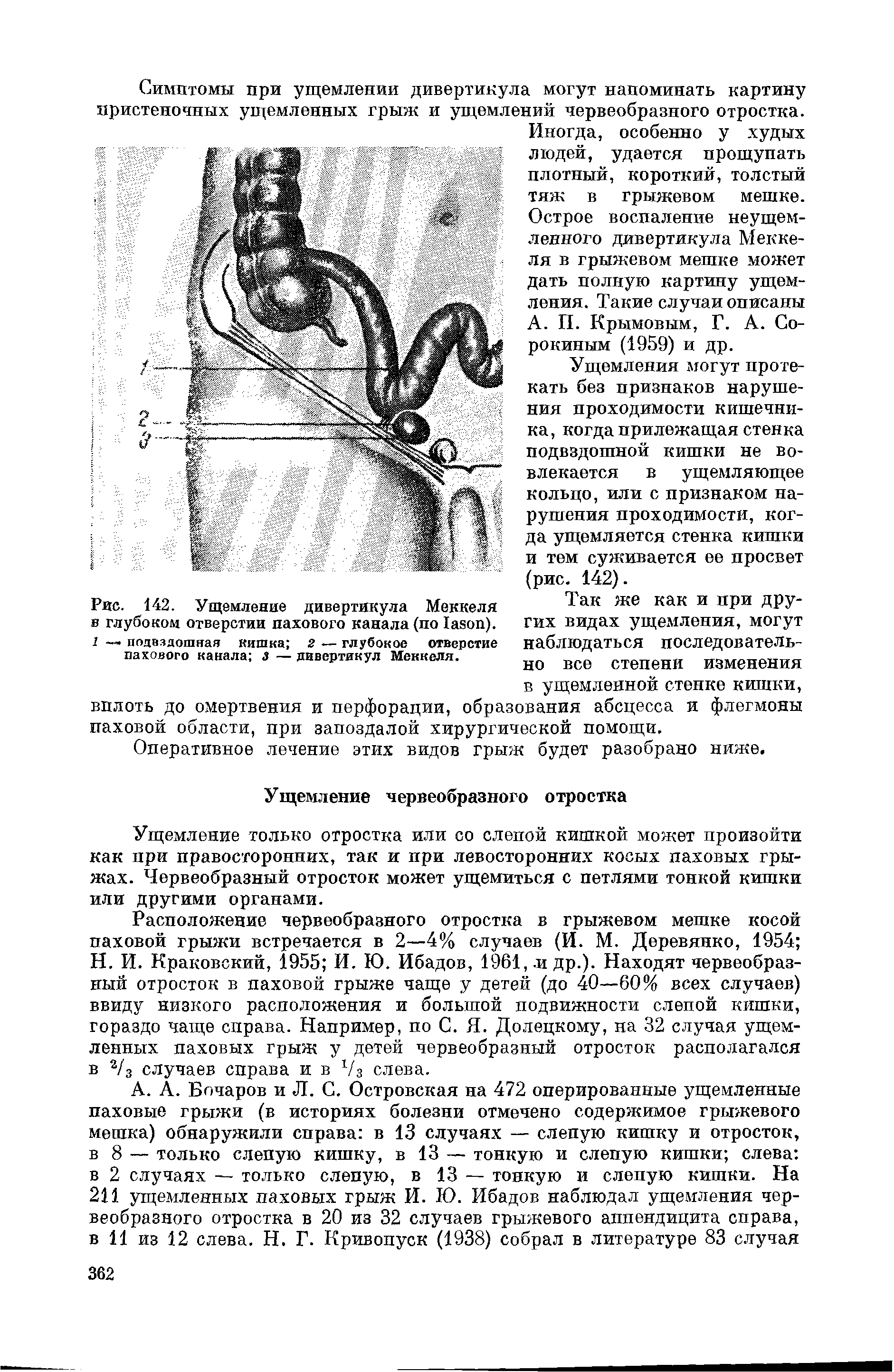 Рис. 142. Ущемление дивертикула Меккеля в глубоком отверстии пахового канала (по Таяоп). 1 — подвздошная кишка 2 — глубокое отверстие пахового канала 3 — дивертикул Меккеля.