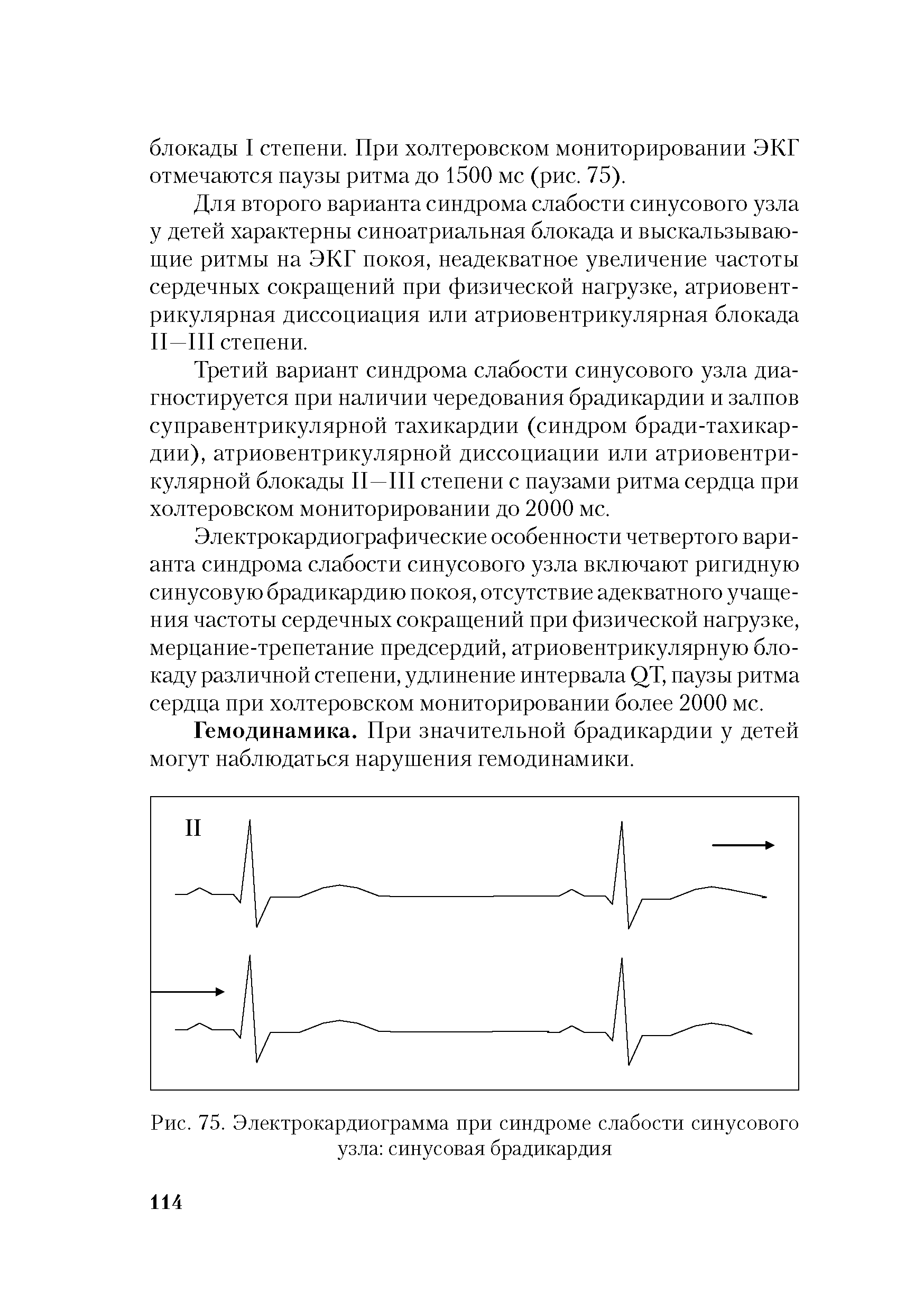 Рис. 75. Электрокардиограмма при синдроме слабости синусового узла синусовая брадикардия...