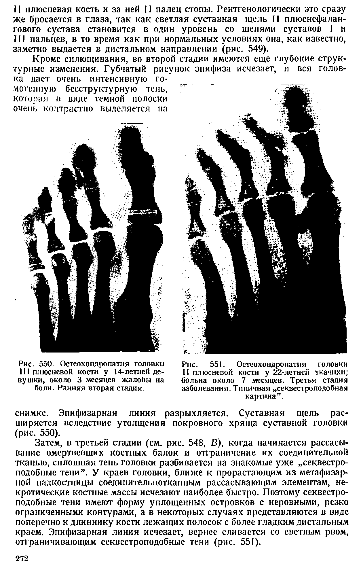 Рис. 551. Остеохондропатия головки II плюсневой кости у 22-летней ткачихи больна около 7 месяцев. Третья стадия заболевания. Типичная секвестроподобная картина .