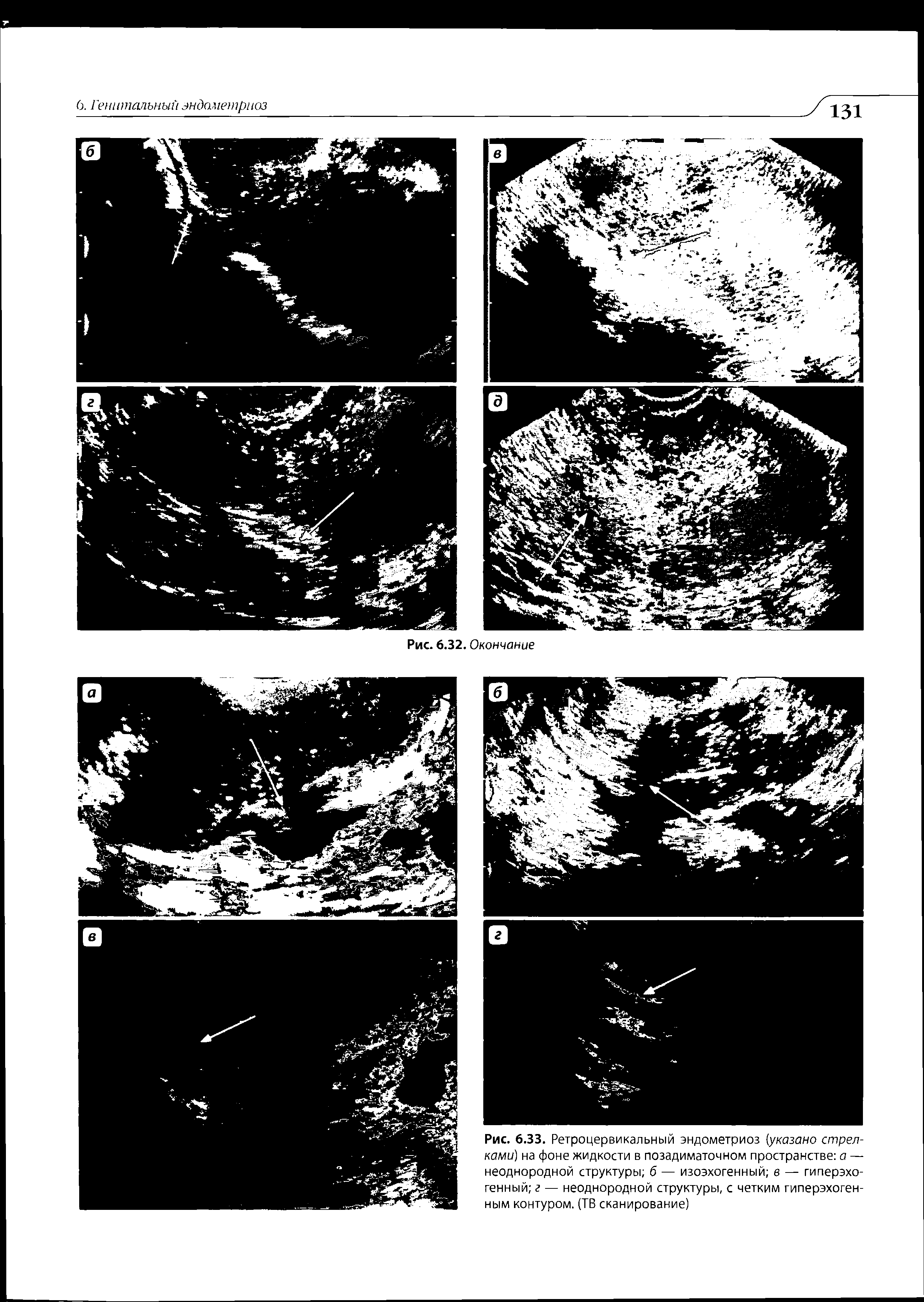 Рис. 6.33. Ретроцервикальный эндометриоз указано стрелками) на фоне жидкости в позадиматочном пространстве а — неоднородной структуры б — изоэхогенный в — гиперэхогенный г — неоднородной структуры, с четким гиперэхогенным контуром. (ТВ сканирование)...