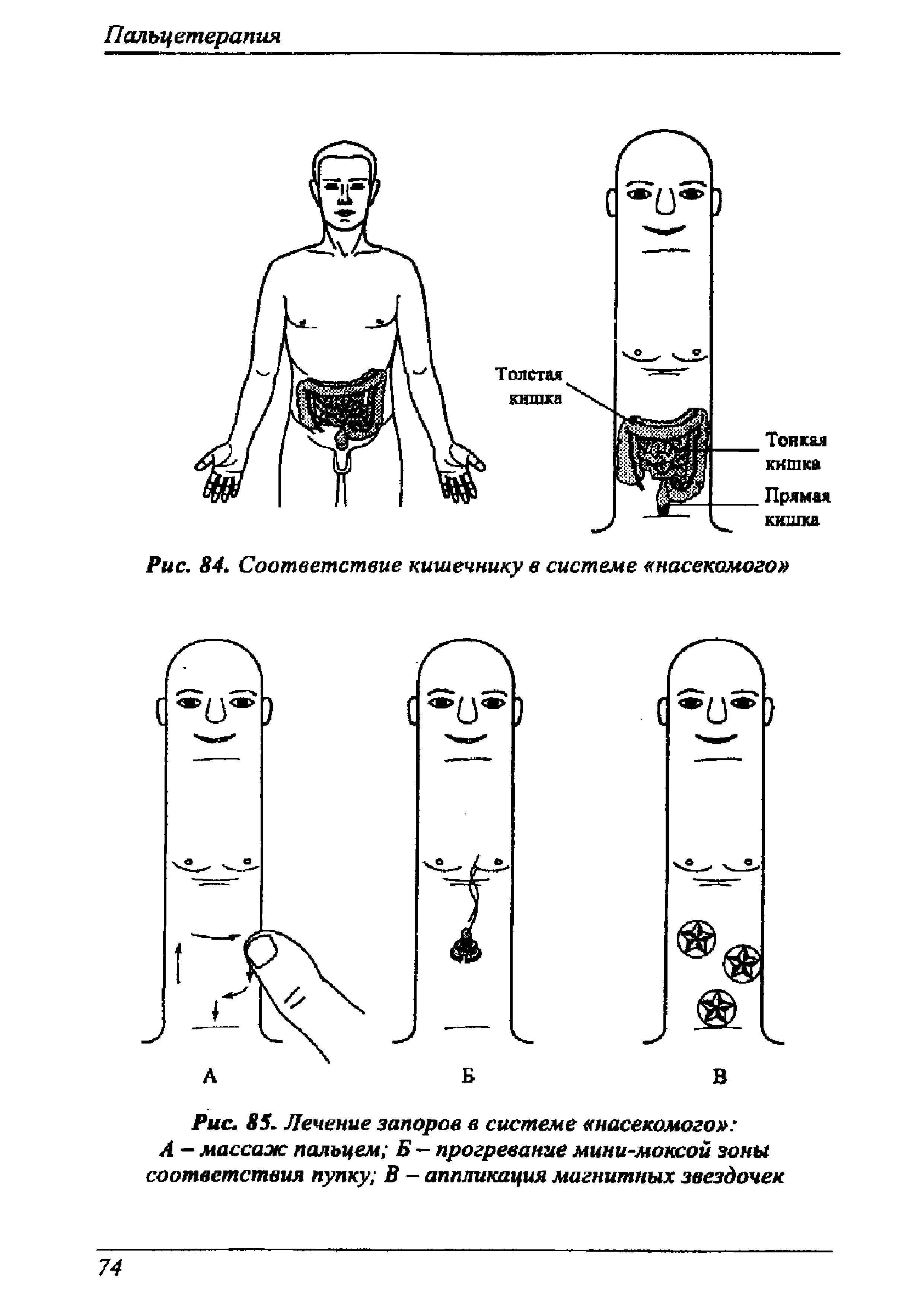 Рис. 85. Лечение запоров в системе насекомого А — массаж пальцем Б — прогревание мини-моксой зоны соответствия пупку В — аппликация магнитных звездочек...