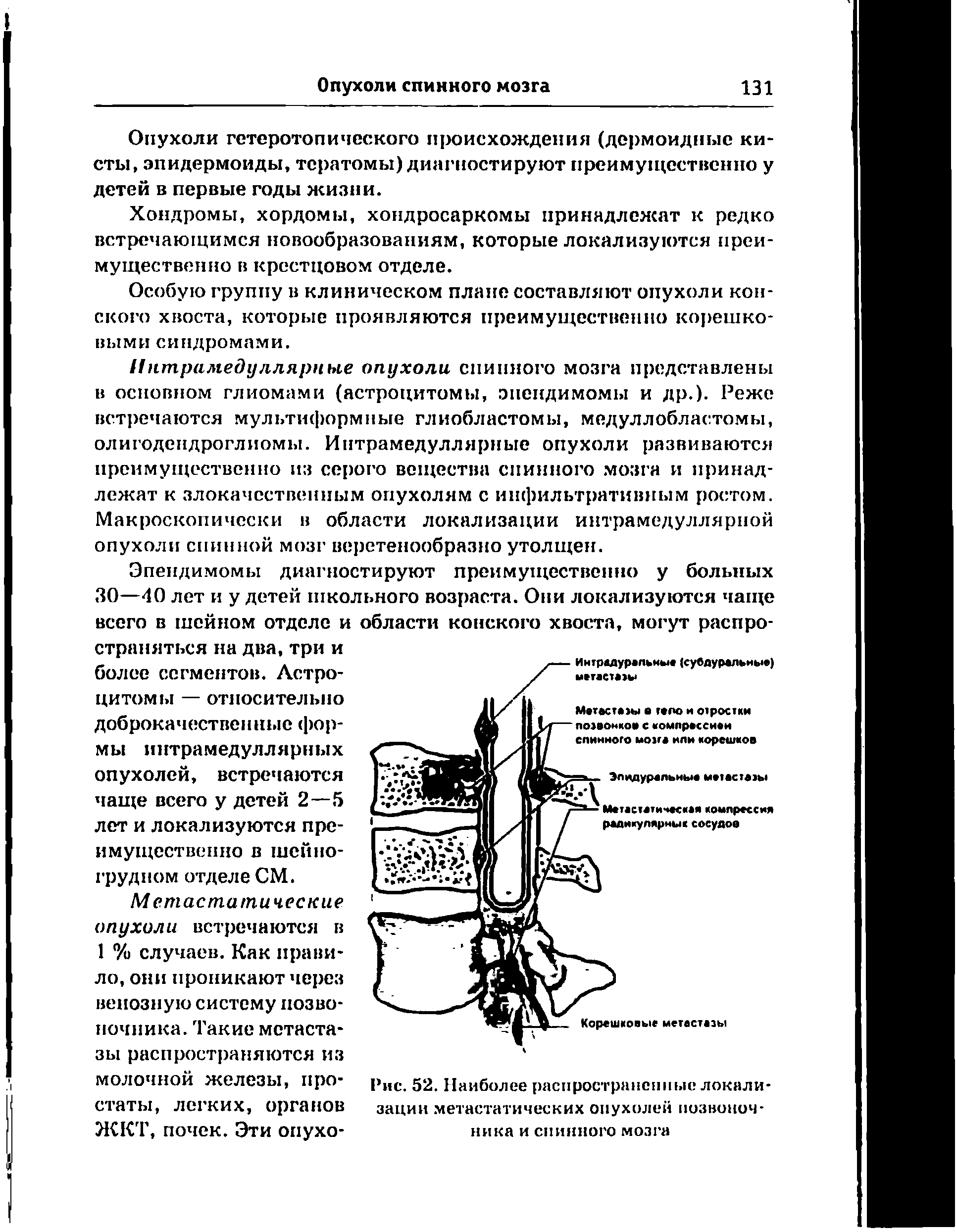 Рис. 52. Наиболее распространенные локализации метастатических опухолей позвоночника и спинного мозга...