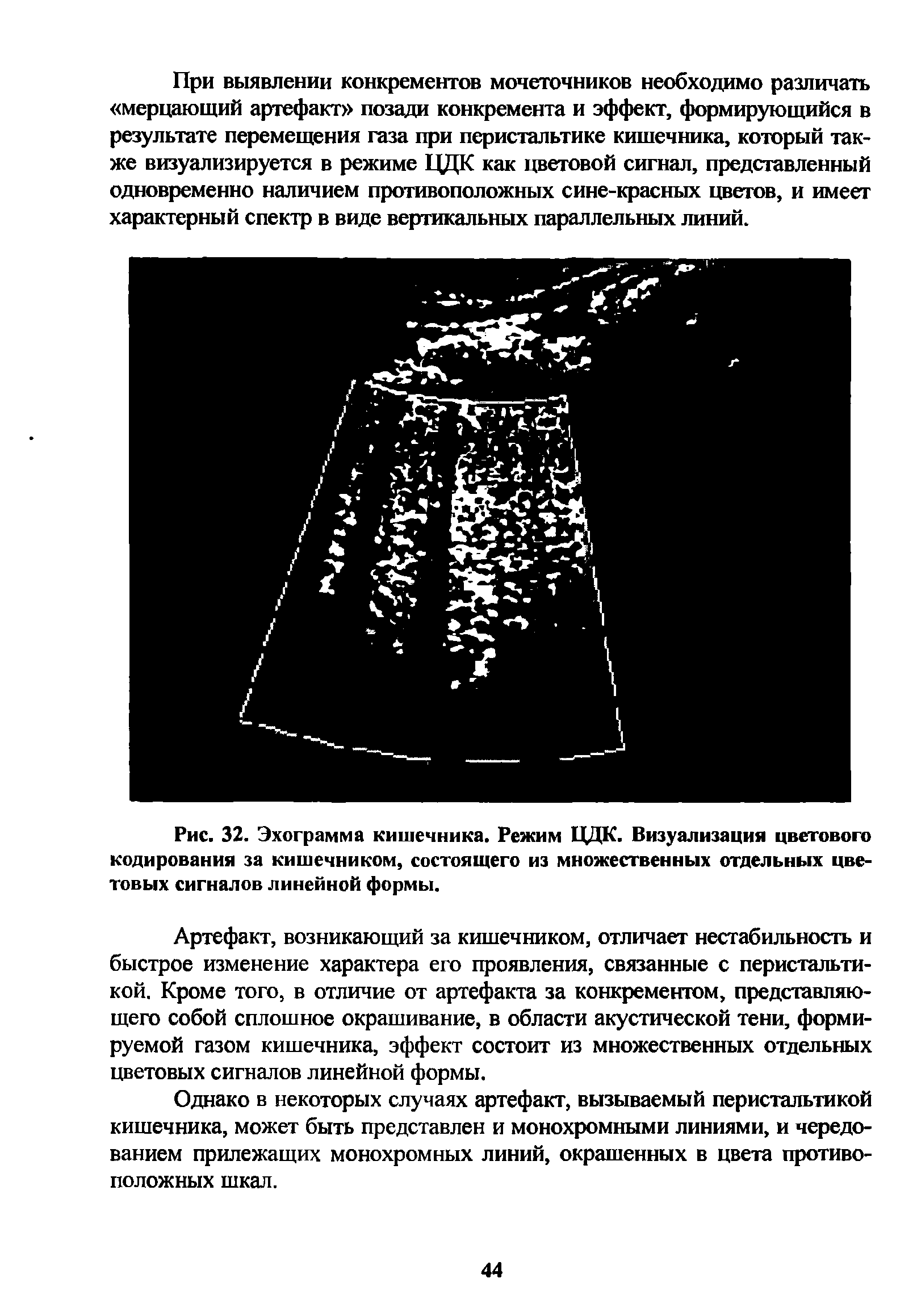 Рис. 32. Эхограмма кишечника. Режим ЦДК. Визуализация цветового кодирования за кишечником, состоящего из множественных отдельных цветовых сигналов линейной формы.