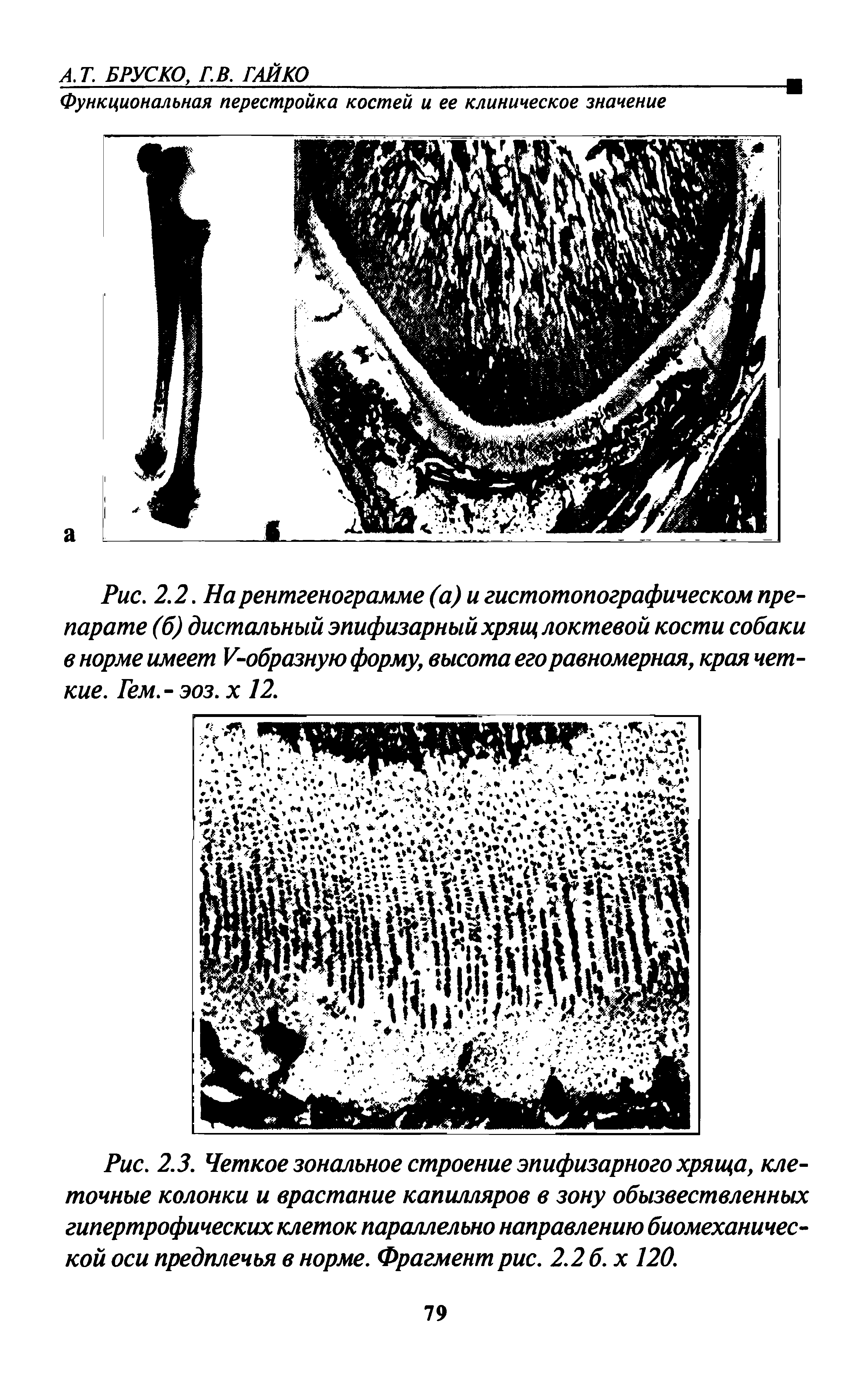 Рис. 2.3. Четкое зональное строение эпифизарного хряща, клеточные колонки и врастание капилляров в зону обызвествленных гипертрофических клеток параллельно направлению биомеханической оси предплечья в норме. Фрагмент рис. 2.2 б. х 120.