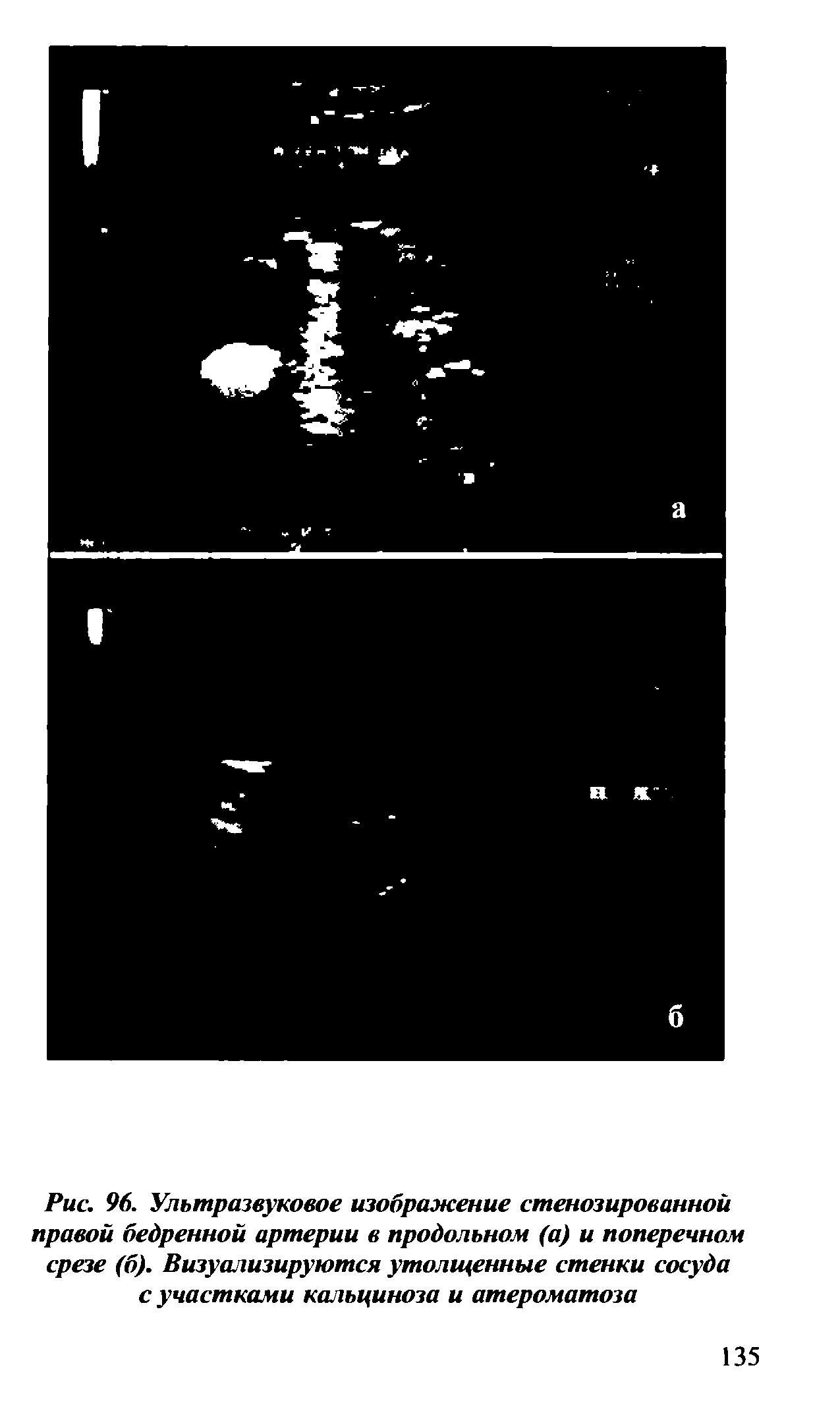 Рис. 96. Ультразвуковое изображение стенозированной правой бедренной артерии в продольном (а) и поперечном срезе (б). Визуализируются утолщенные стенки сосуда с участками кальциноза и атероматоза...