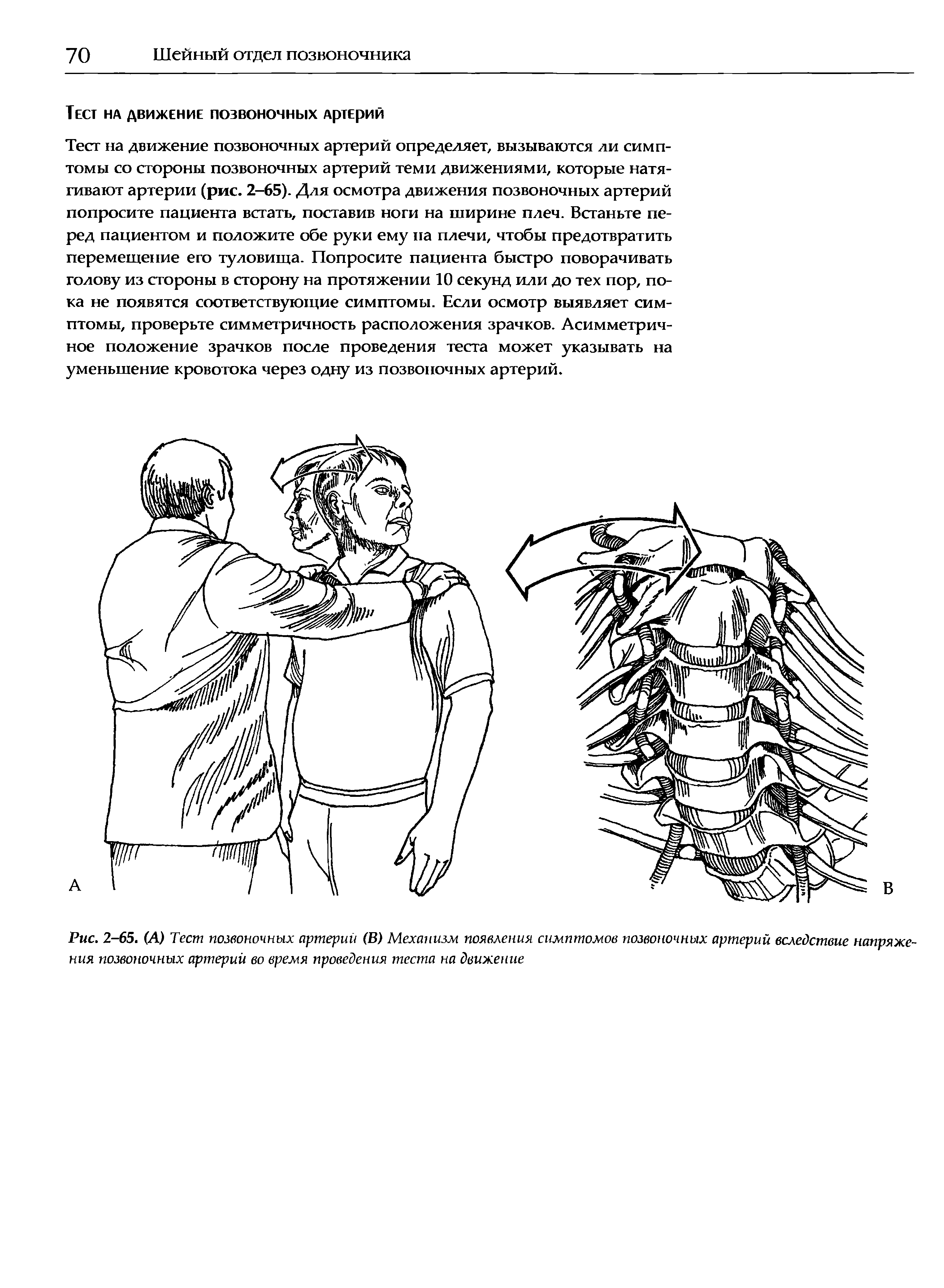 Рис. 2-65. (А) Тест позвоночных артерий (В) Механизм появления симптомов позвоночных артерий вследствие напряжения позвоночных артерий во время проведения теста на движение...