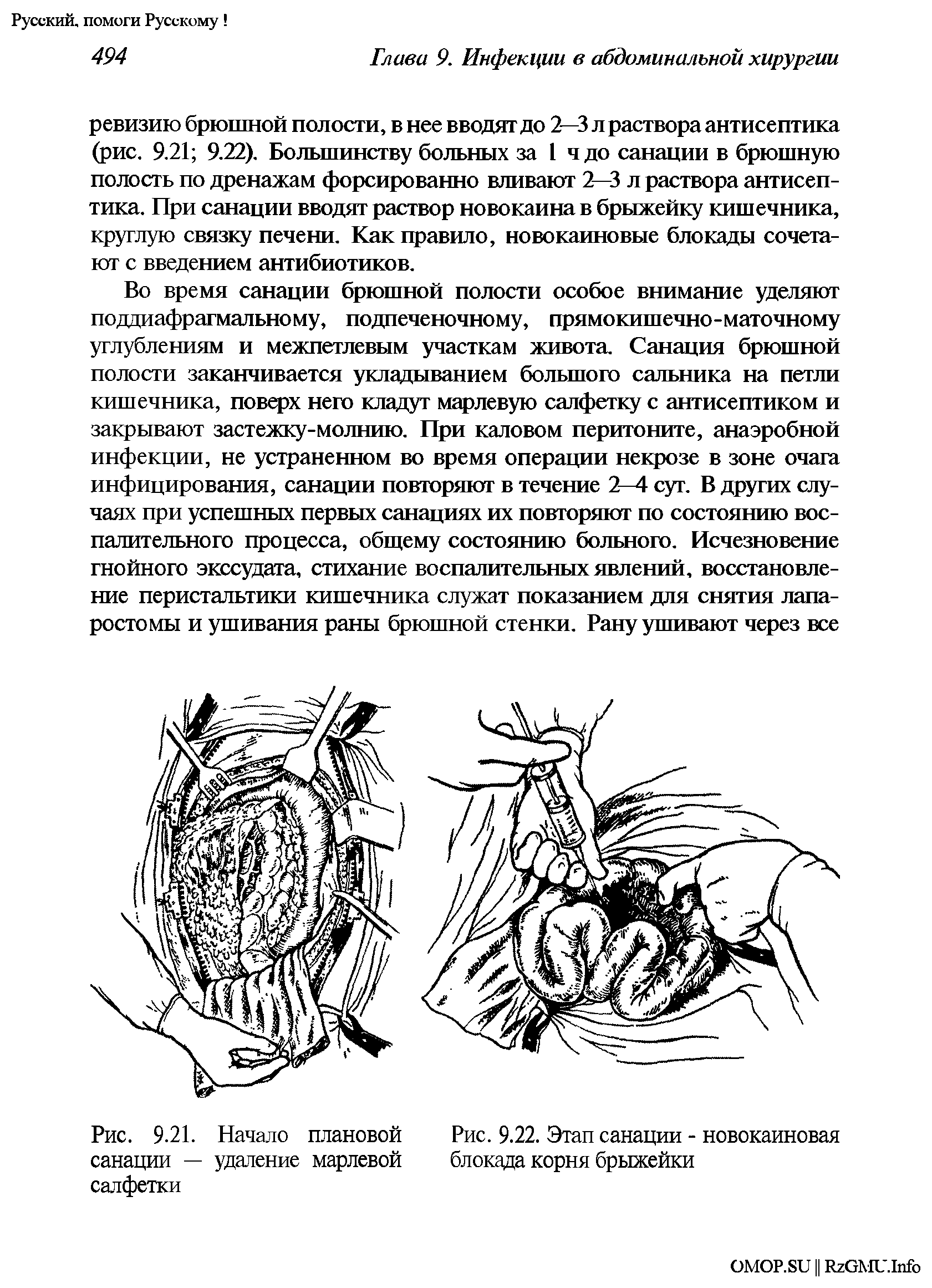 Рис. 9.22. Этап санации - новокаиновая блокада корня брыжейки...