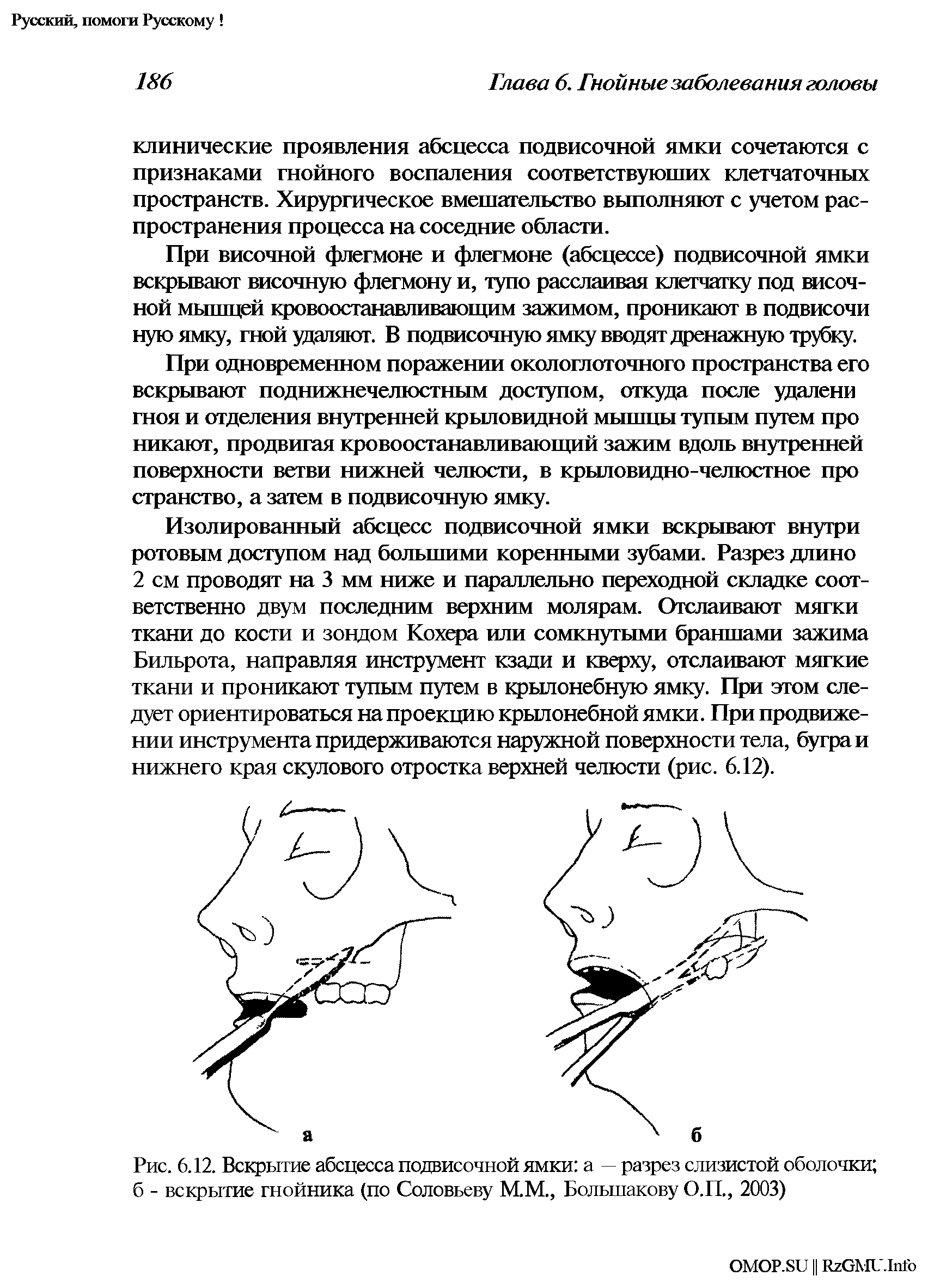 Рис. 6.12. Вскрытие абсцесса подвисочной ямки а — разрез слизистой оболочки б - вскрытие гнойника (по Соловьеву М.М., Большакову О.П., 2003)...