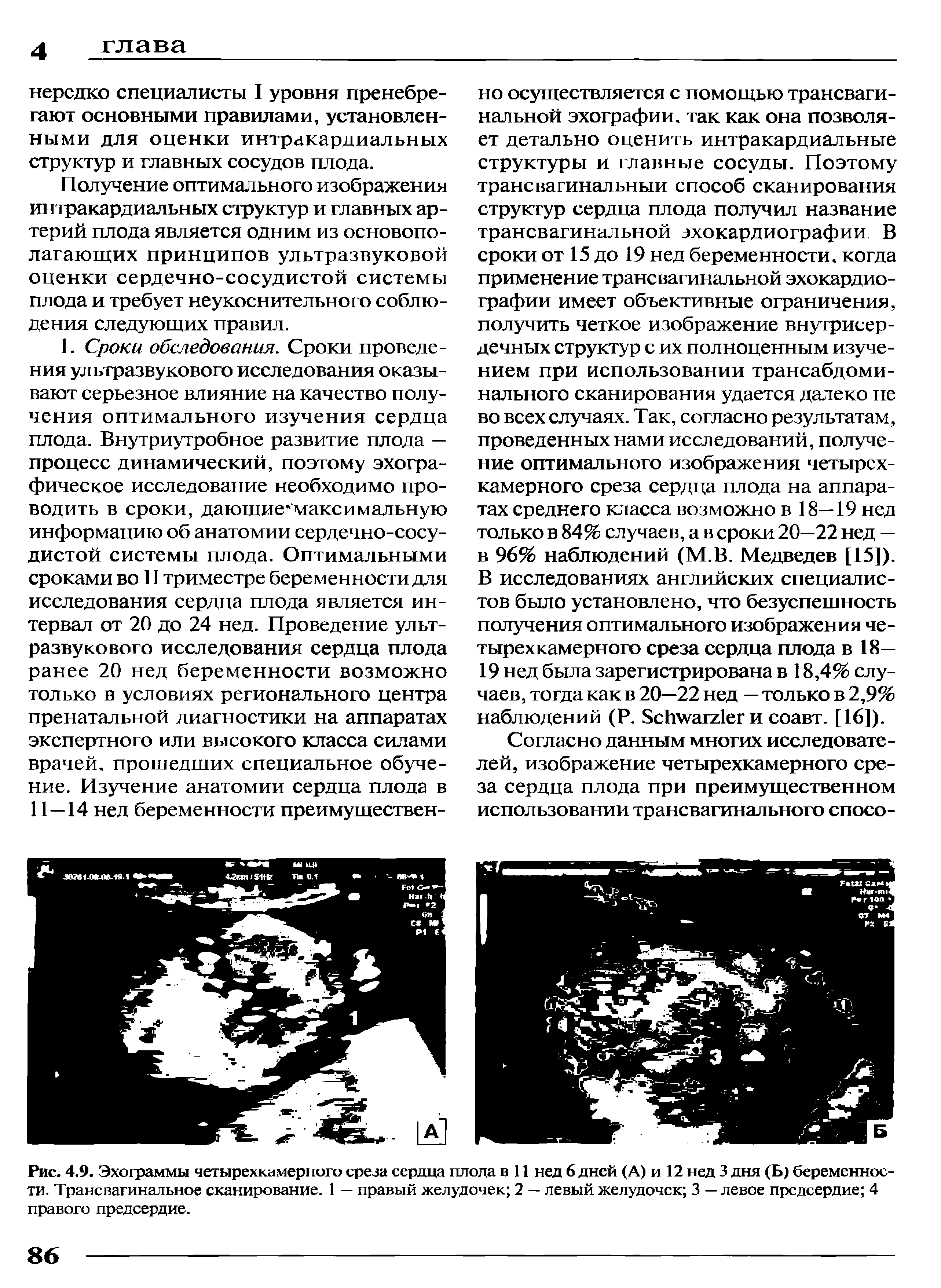 Рис. 4.9. Эхограммы четырехкамерного среза сердца плода в 11 нед 6 дней (А) и 12 нед 3 дня (Б) беременнос-...