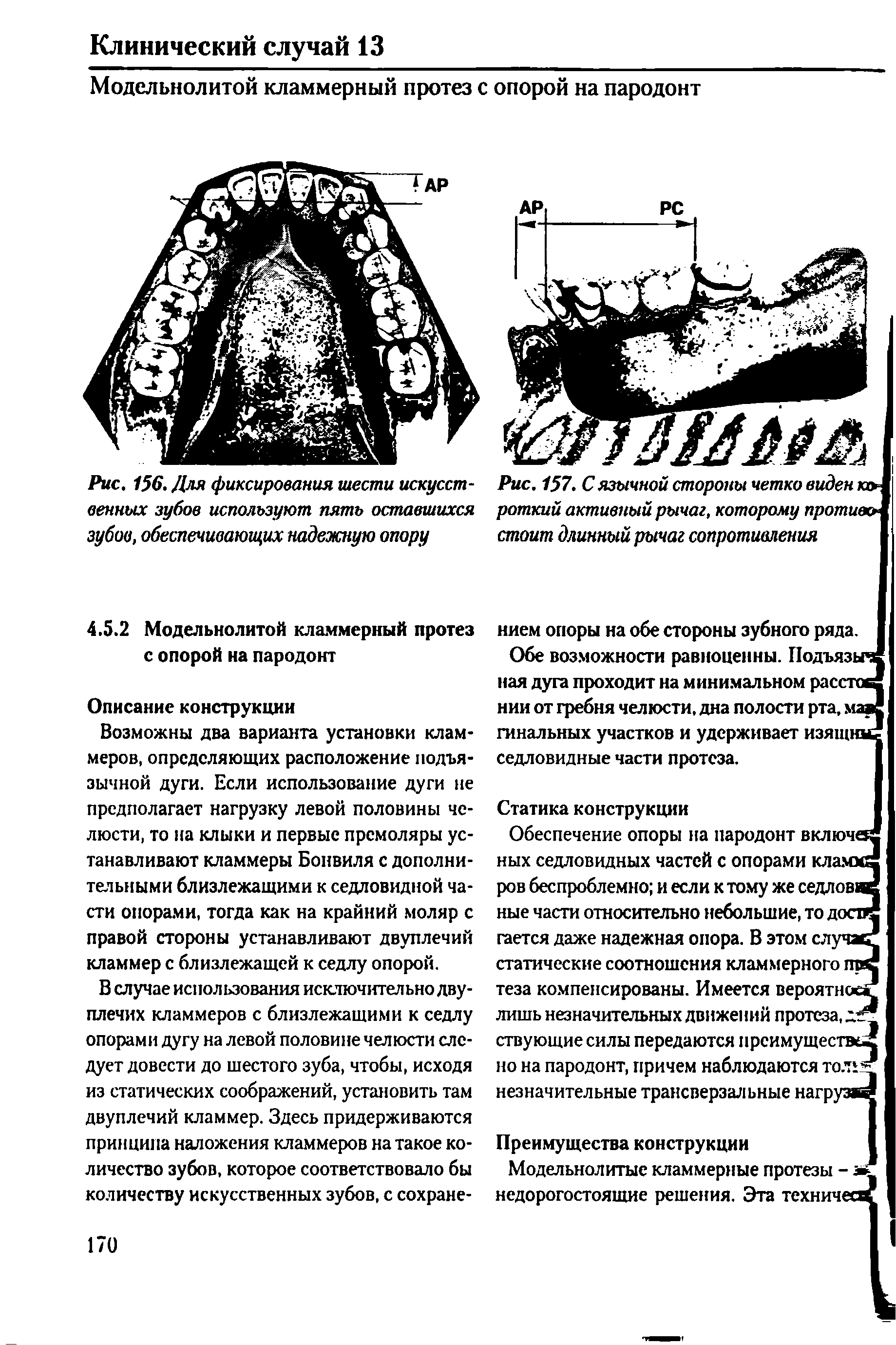 Рис. 157. С язычной стороны четко виден короткий активный рычаг, которому противостоит длинный рычаг сопротивления...