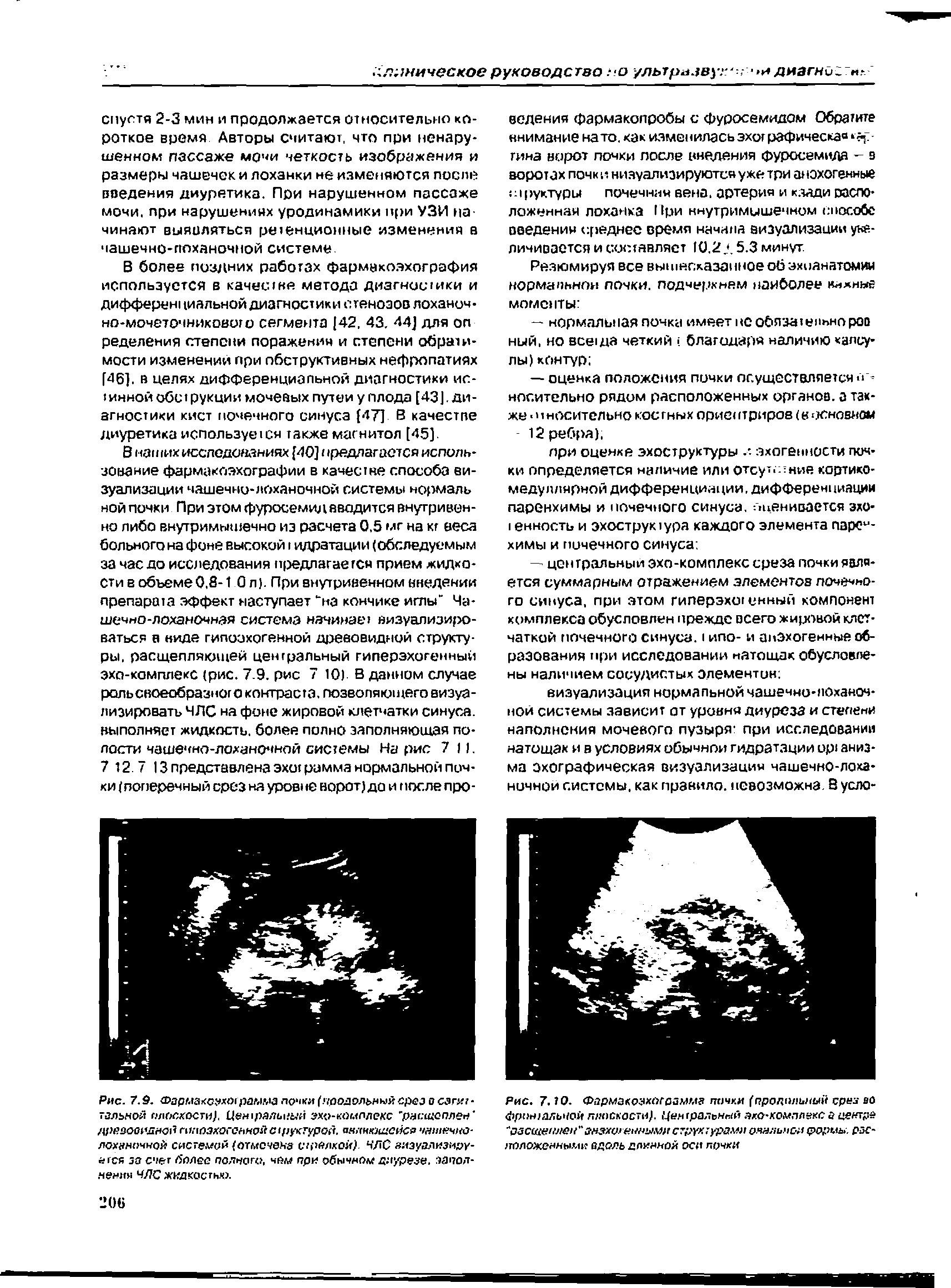 Рис. 7.9. Фармакоахырамма почки (продольный срез о сагиг-гзльной лгхжости/ эхо-комплекс расщеплен ...