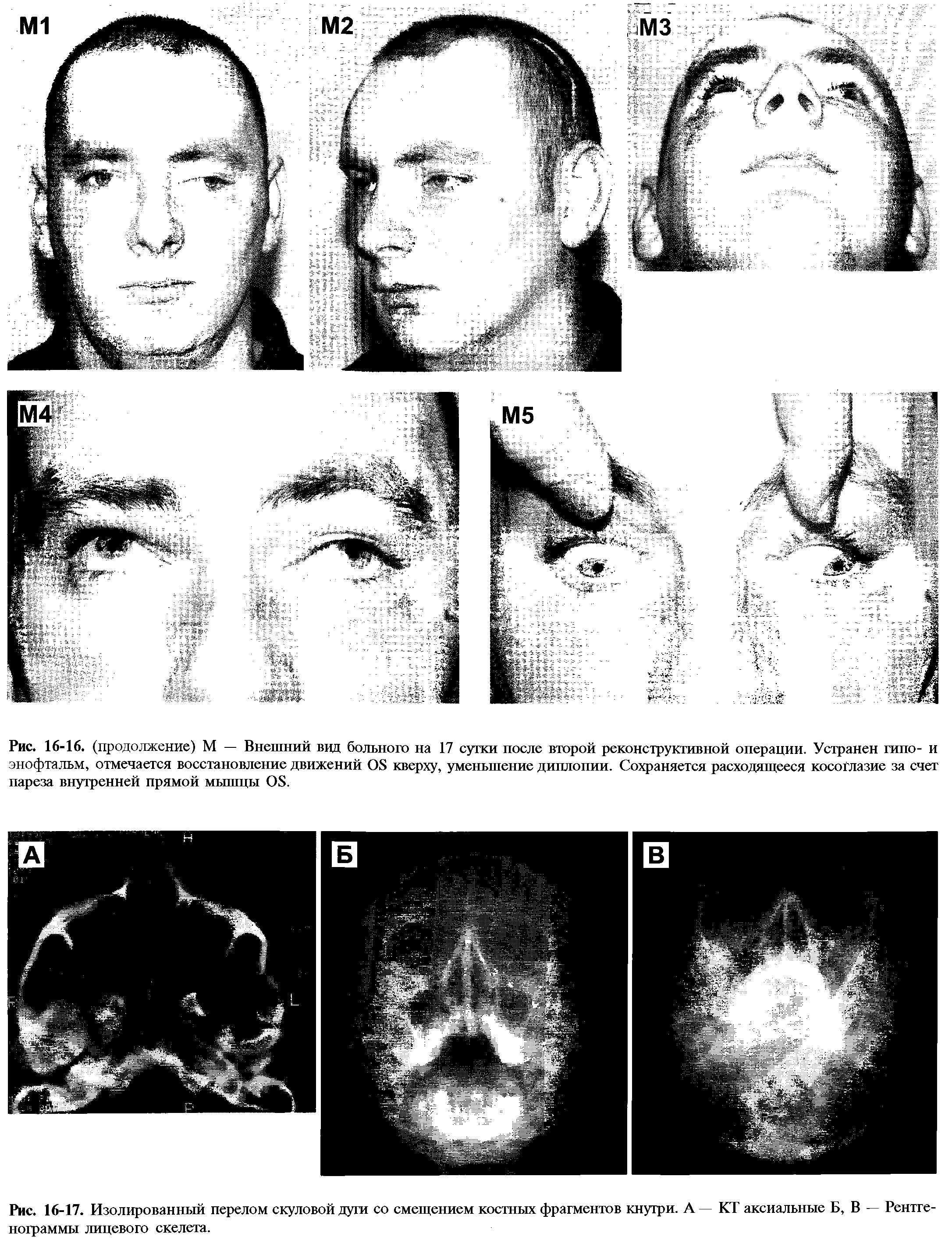Рис. 16-17. Изолированный перелом скуловой дуги со смещением костных фрагментов кнутри. А — КТ аксиальные Б, В — Рентгенограммы лицевого скелета.