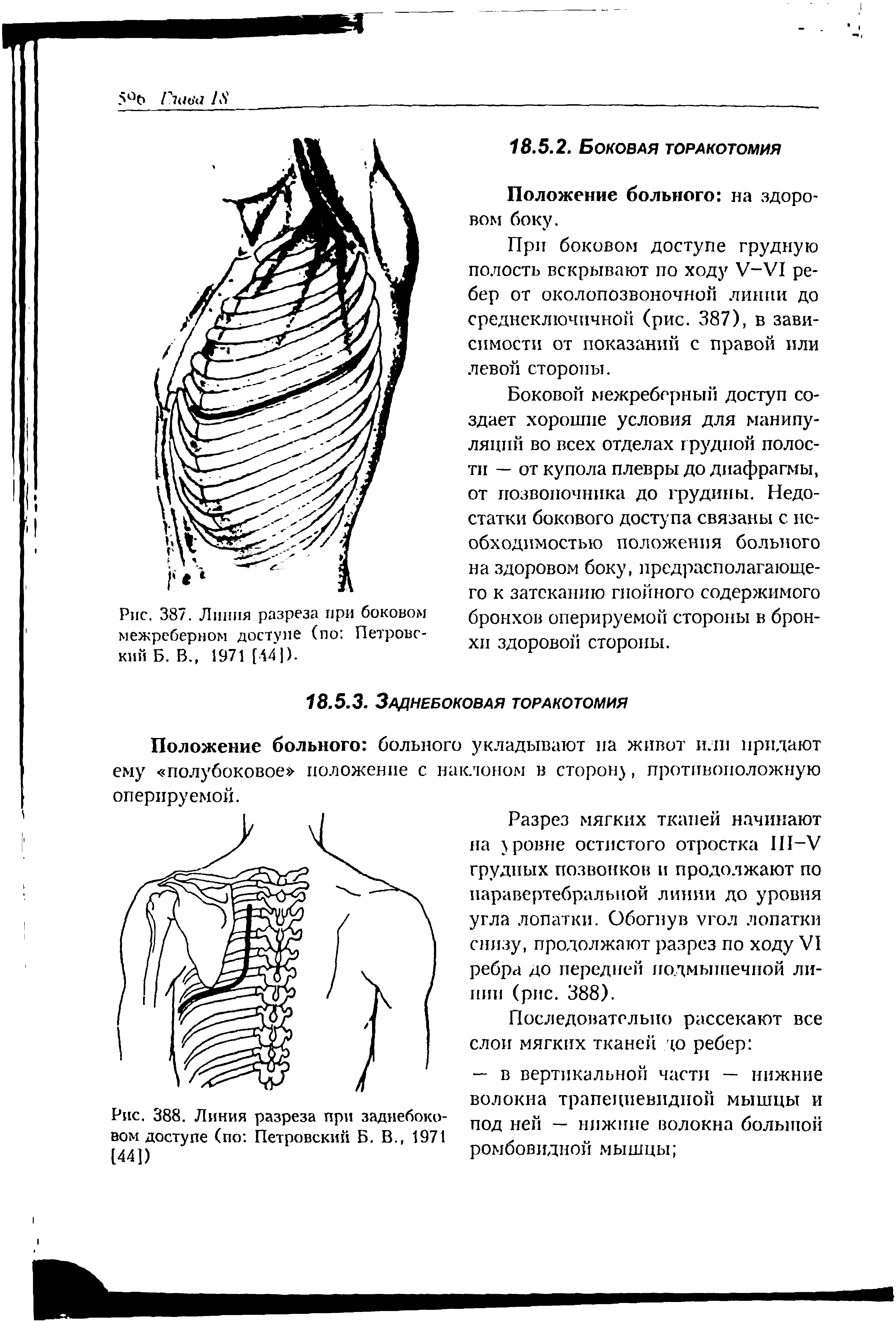 Рис. 387. Линия разреза при боковом межреберном доступе (по Петровский Б. В., 1971 [441).