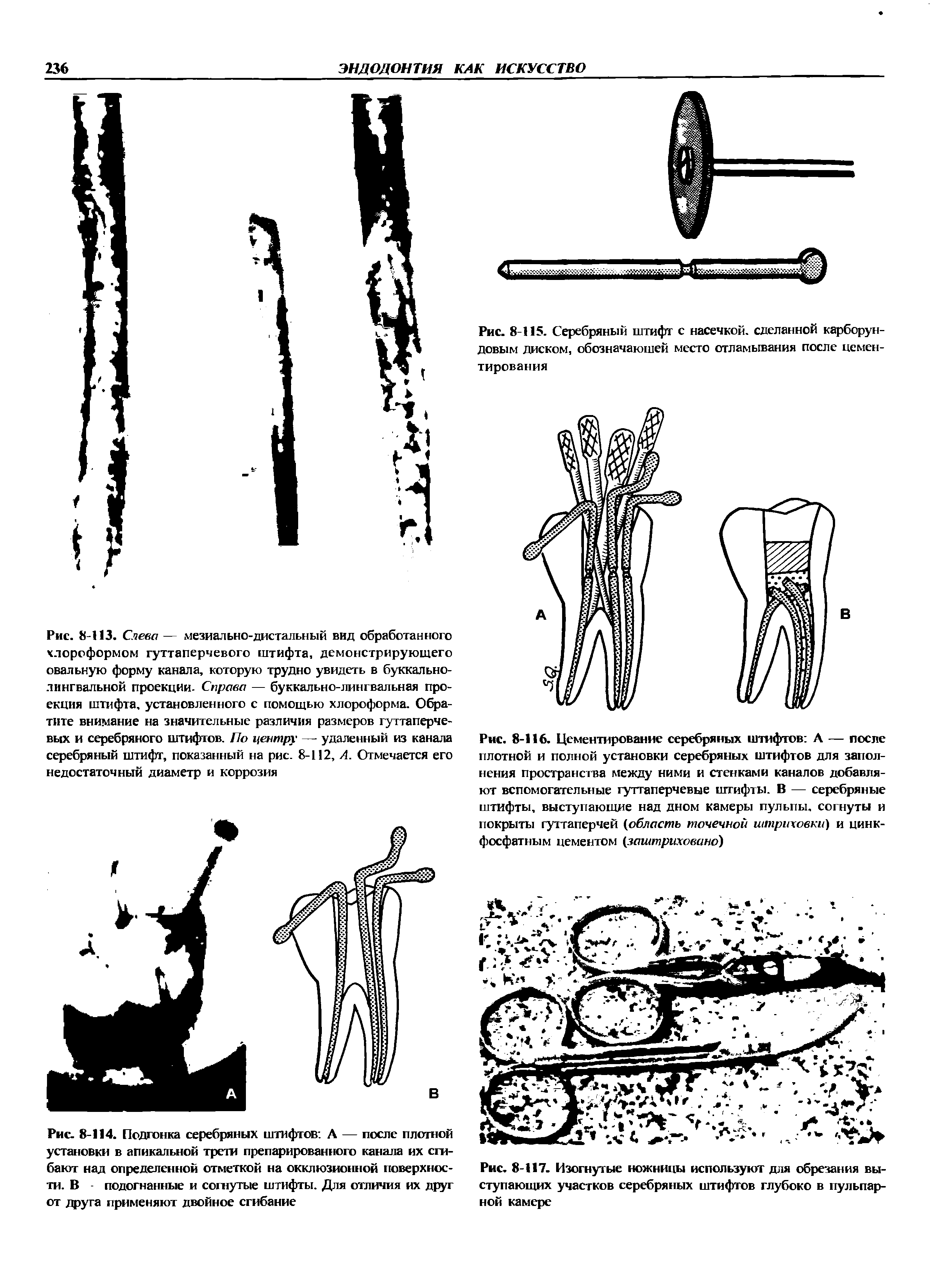 Рис. 8-117. Изогнутые ножницы используют для обрезания выступающих участков серебряных штифтов глубоко в пульпарной камере...