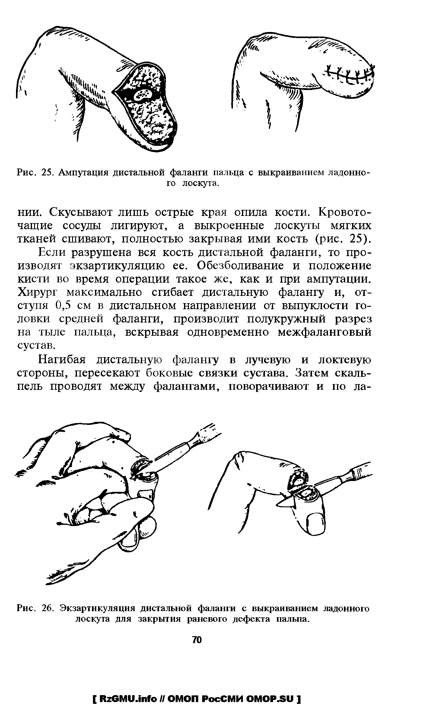 Рис. 26. Экзартикуляция дистальной фаланги с выкраиванием ладонного лоскута для закрытия раневого дефекта пальпа.