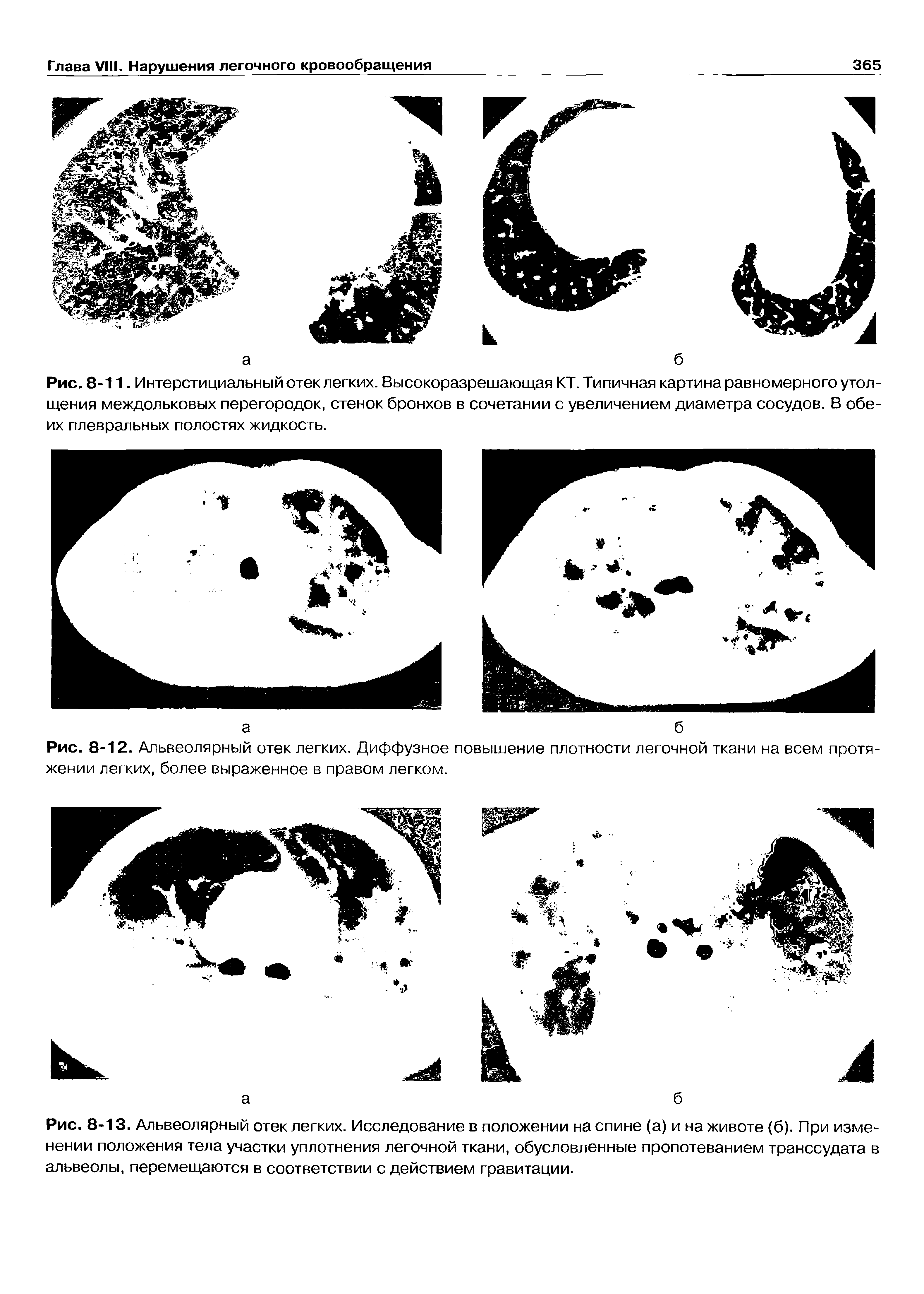 Рис. 8-13. Альвеолярный отек легких. Исследование в положении на спине (а) и на животе (б). При изменении положения тела участки уплотнения легочной ткани, обусловленные пропотеванием транссудата в альвеолы, перемещаются в соответствии с действием гравитации.