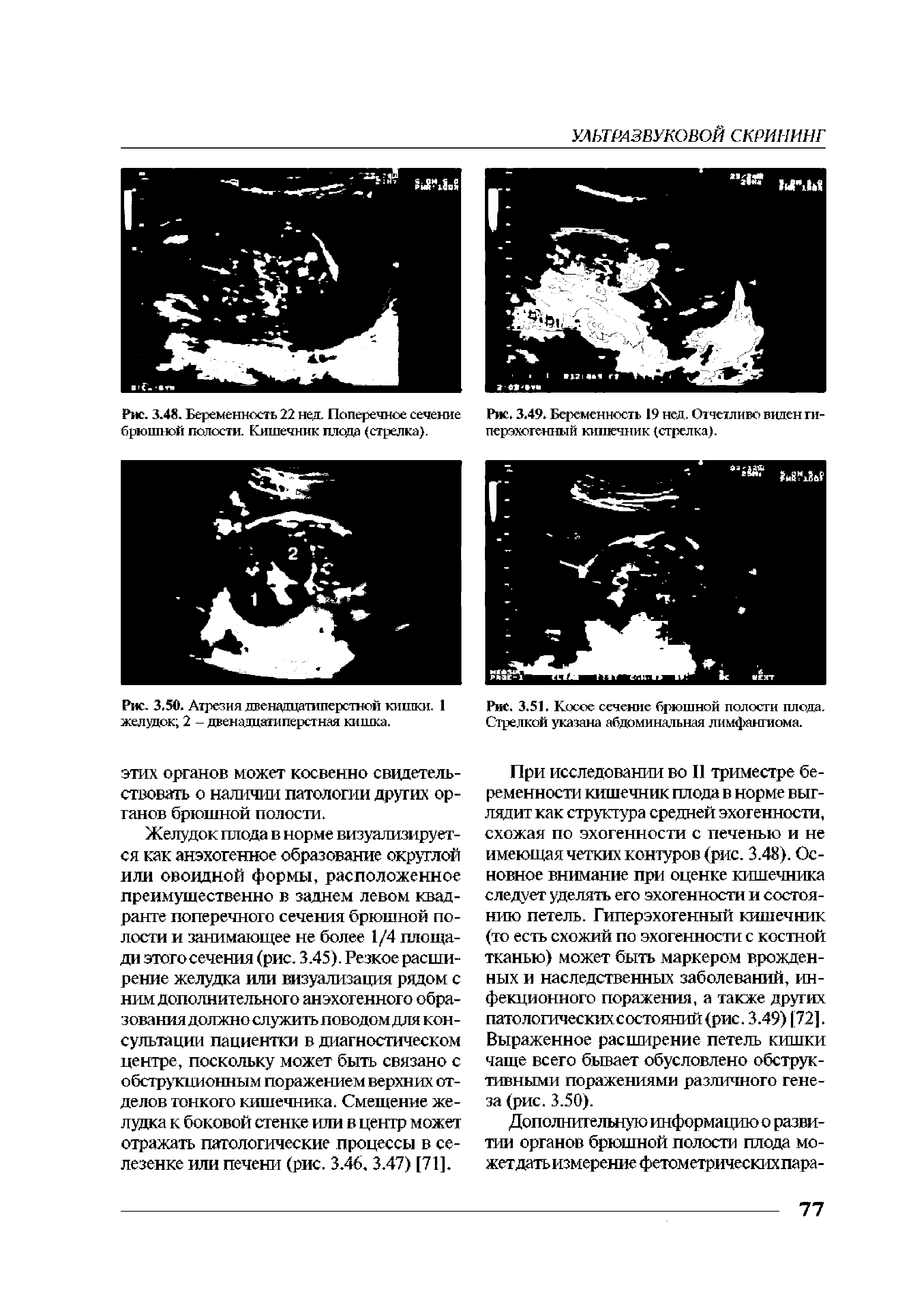 Рис. 3.51. Косое сечение брюшной полости плода. Стрелкой указана абдоминальная лимфангиома.