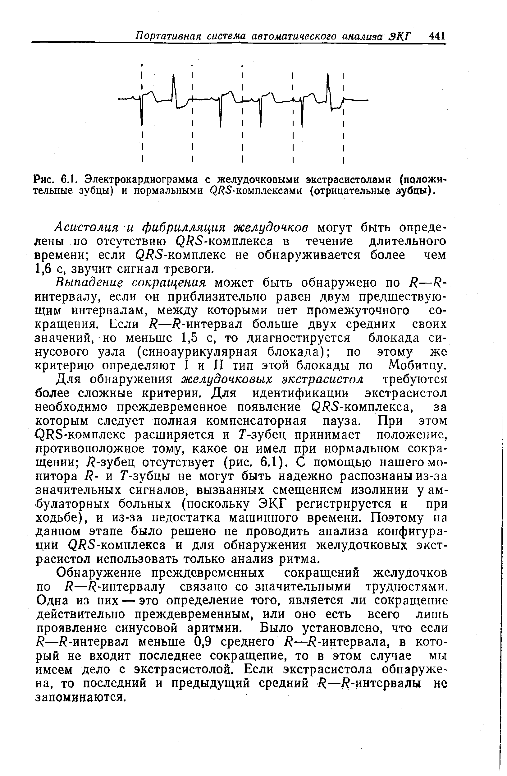 Рис. 6.1. Электрокардиограмма с желудочковыми экстрасистолами (положительные зубцы) и нормальными ( ./ 5-комплексами (отрицательные зубцы).