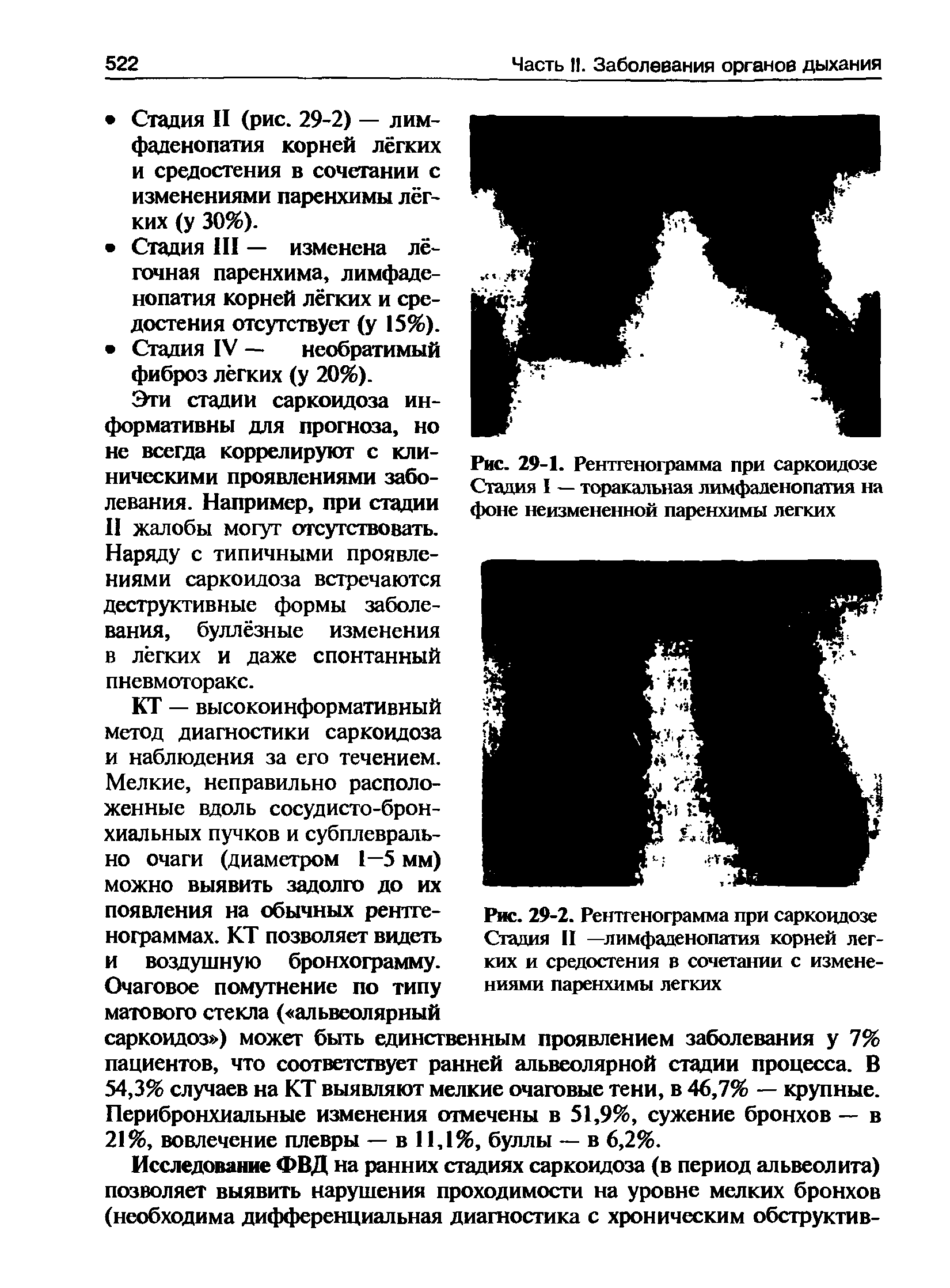 Рис. 29-2. Рентгенограмма при саркоидозе Стадия II —лимфаденопатия корней легких и средостения в сочетании с изменениями паренхимы легких...