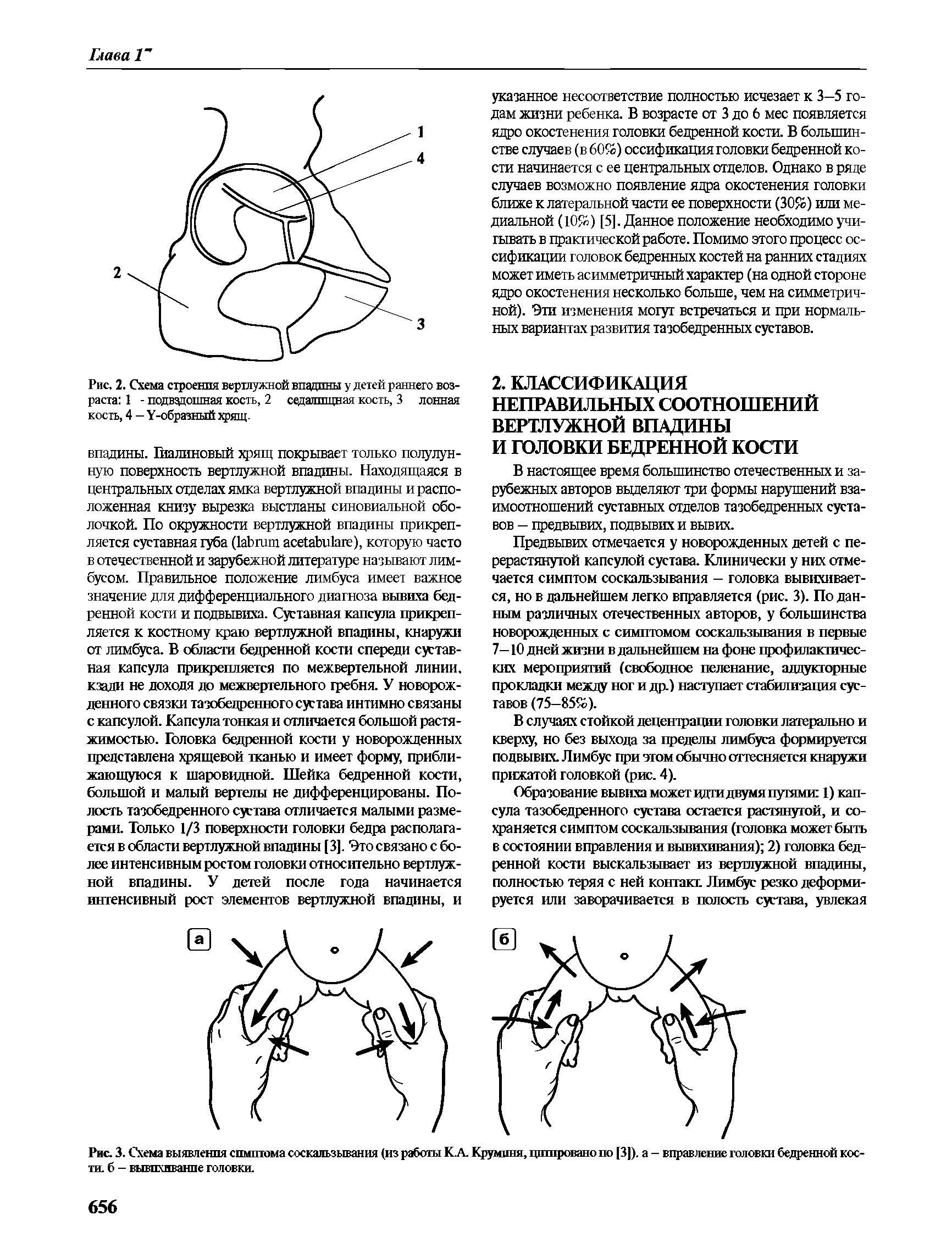 Рис. 3. Схема выявления симптома соскальзывания (из работы К.А. Крумпня, цитировано по [3]). а - вправление головки бедренной кости, б - вывихивание головки.