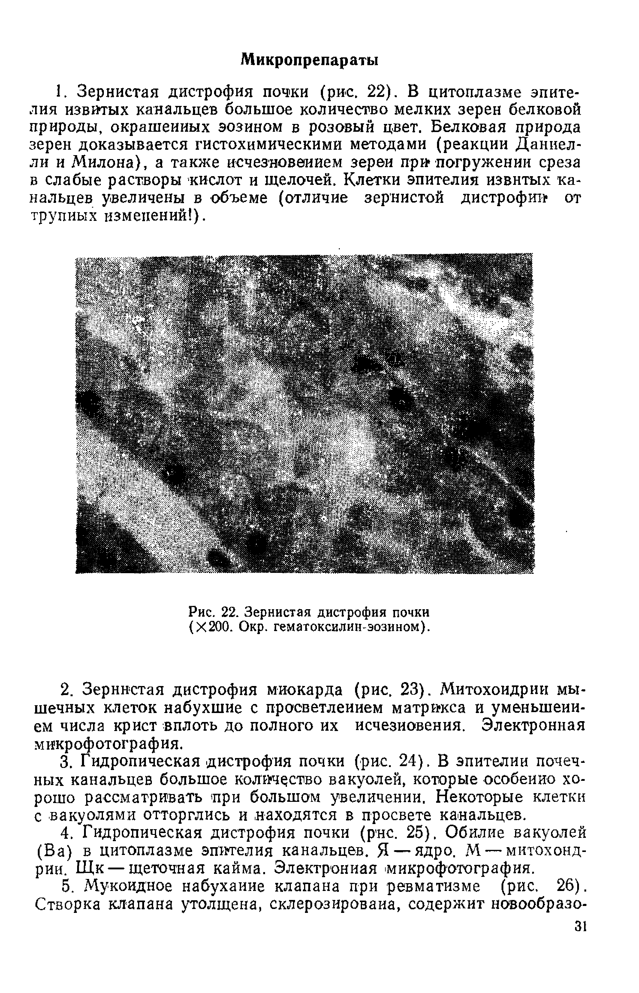 Рис. 22. Зернистая дистрофия почки (Х200. Окр. гематоксилин эозином).