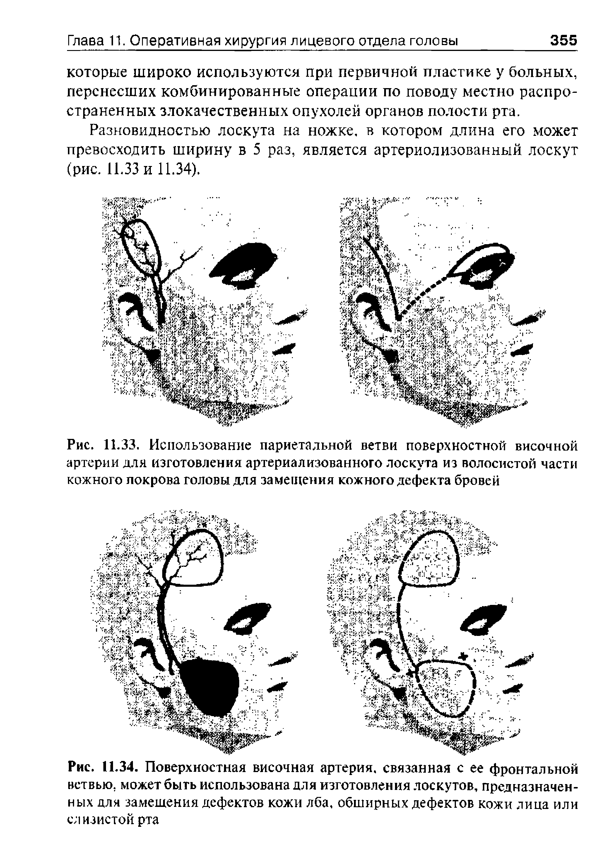 Рис. 11.34. Поверхностная височная артерия, связанная с ее фронтальной ветвью, может быть использована для изготовления лоскутов, предназначенных для замещения дефектов кожи лба, обширных дефектов кожи лица или слизистой рта...