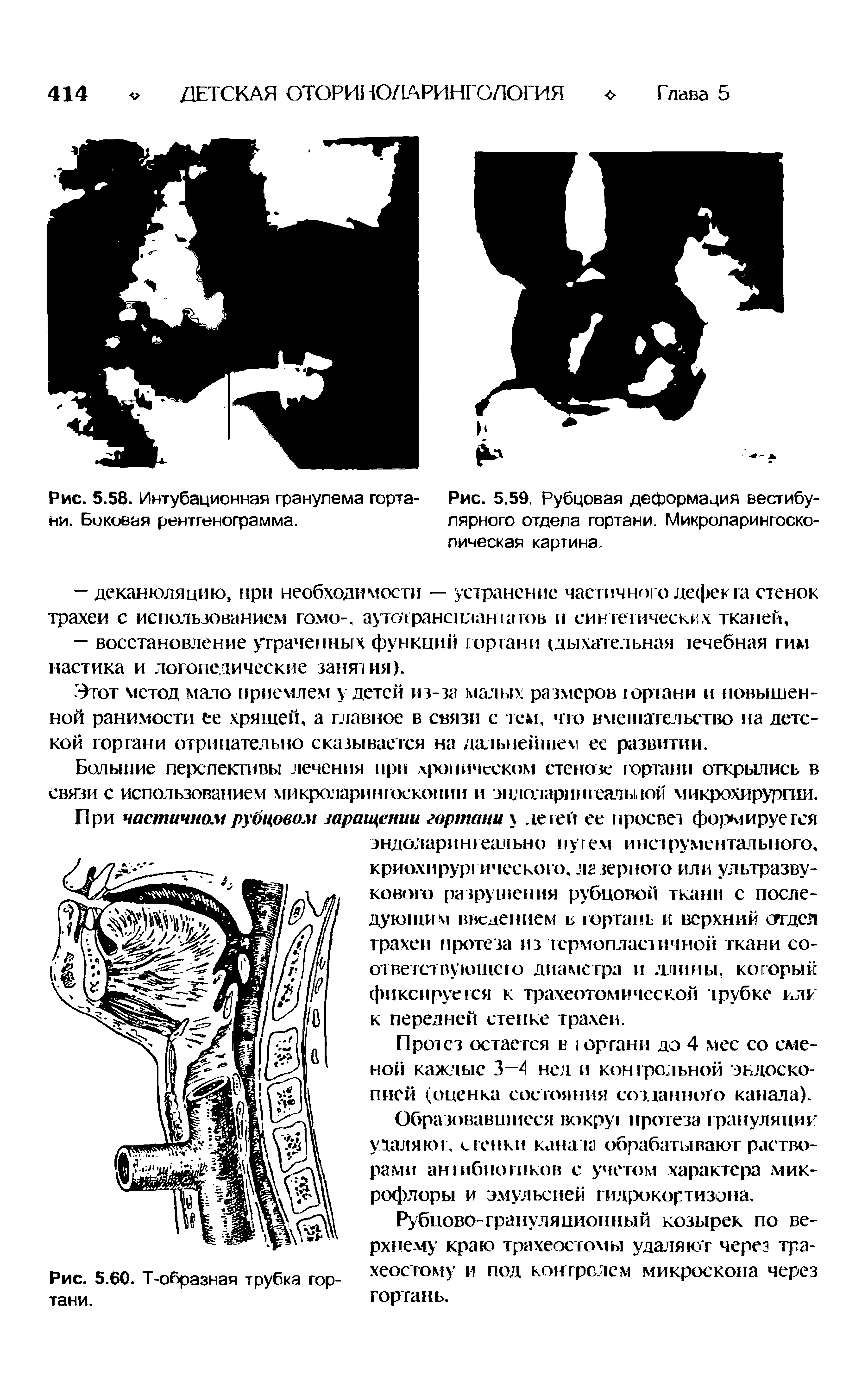 Рис. 5.58. Интубационная гранулема горта- Рис. 5.59, Рубцовая деформация вестибу-ни. Боковая рентгенограмма. лярного отдела гортани. Микроларингоско-...