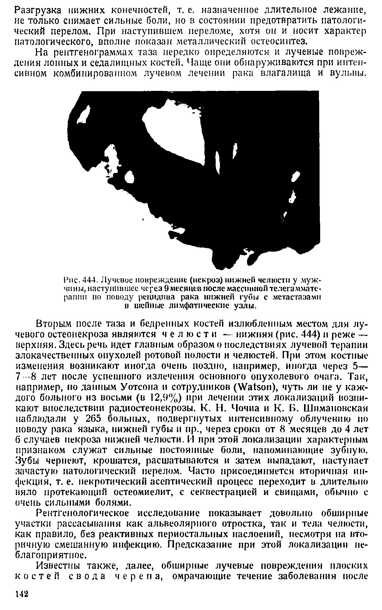 Рис. 444. Лучевое повреждение (некроз) нижней челюсти у мужчины, наступившее через 9 месяцев после массивной телегаммате-рапии по поводу рецидива рака нижней губы с метастазами в шейные лимфатические узлы.