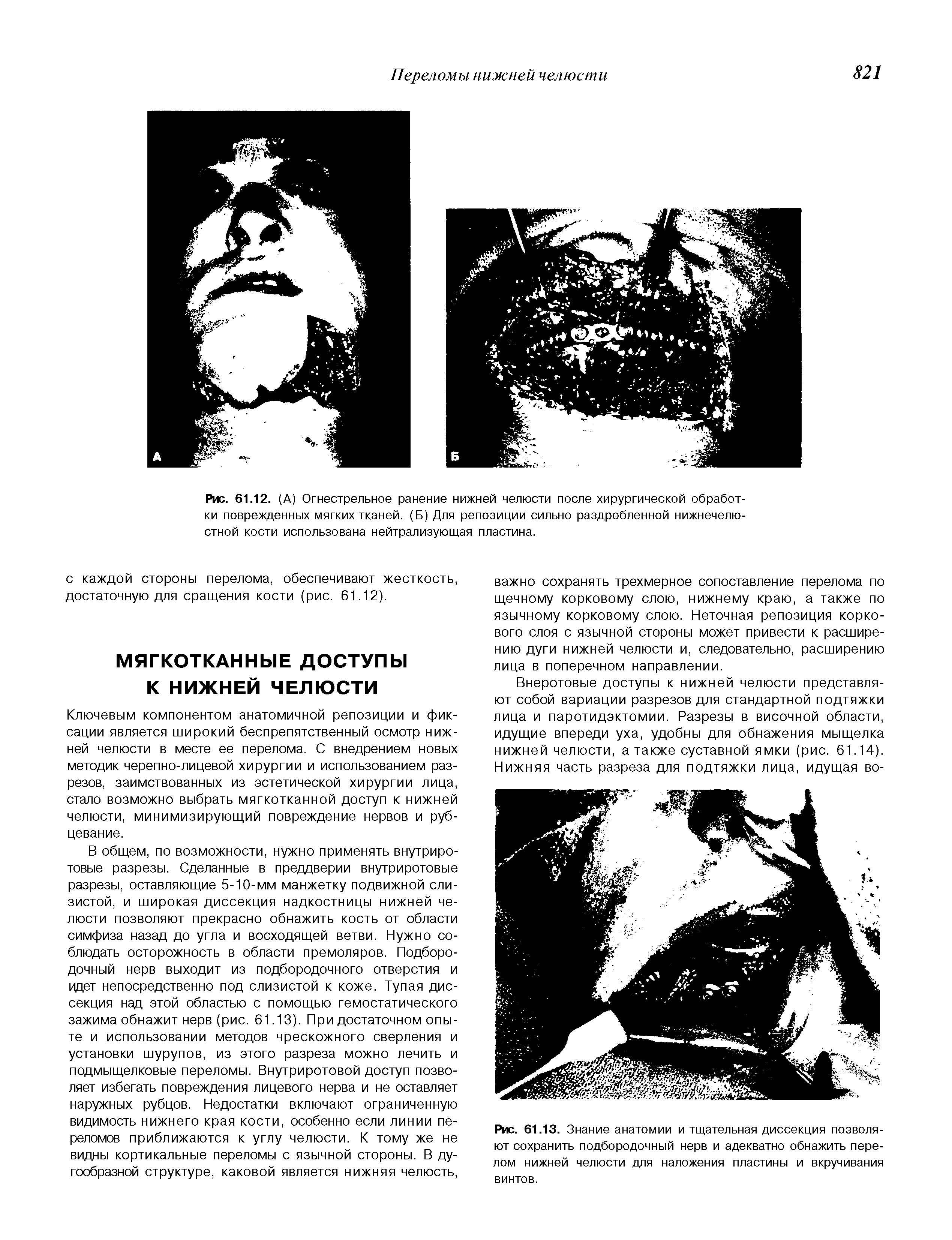 Рис. 61.12. (А) Огнестрельное ранение нижней челюсти после хирургической обработки поврежденных мягких тканей. (Б) Для репозиции сильно раздробленной нижнечелюстной кости использована нейтрализующая пластина.